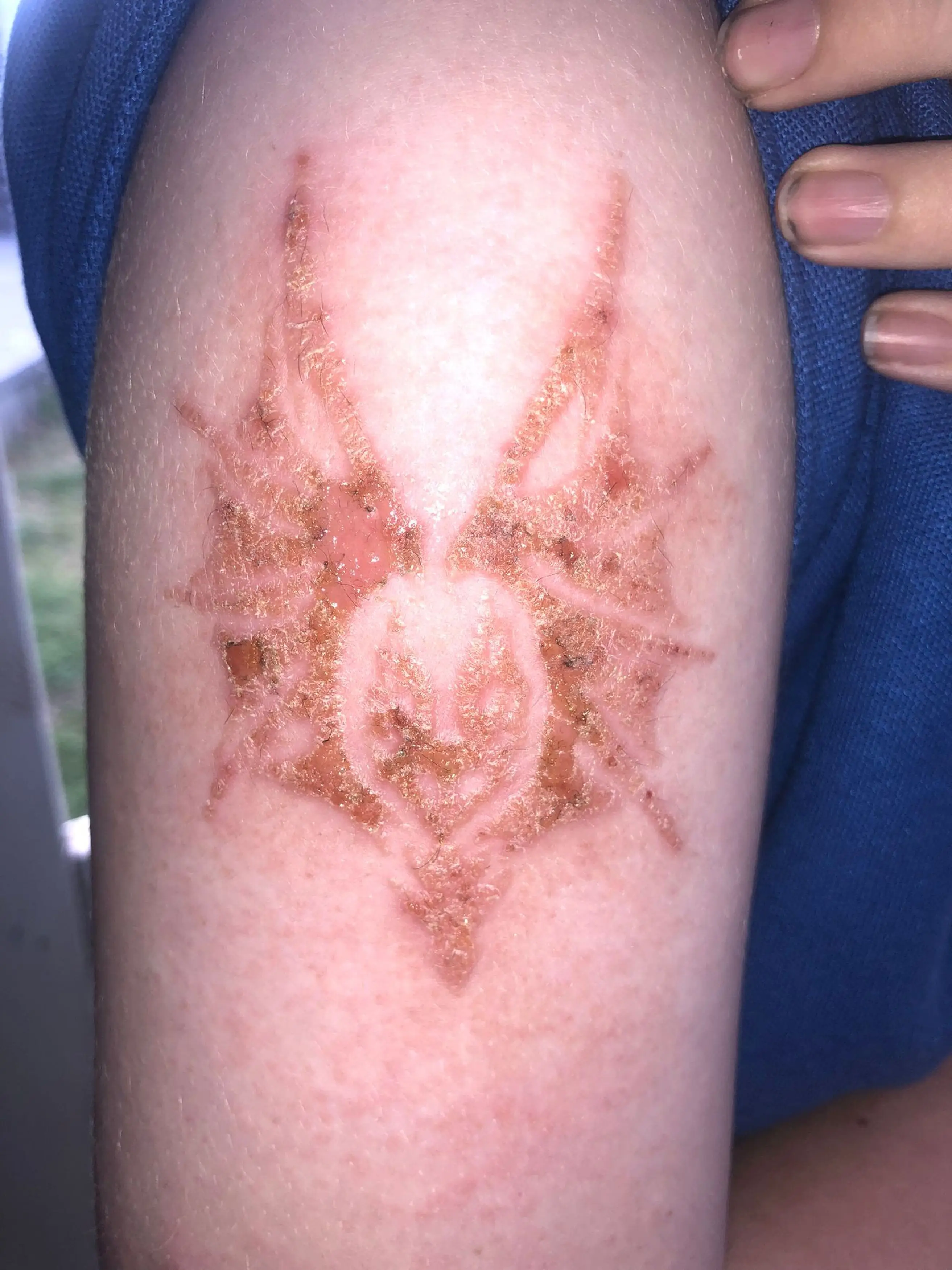 Caden had to take time off school.