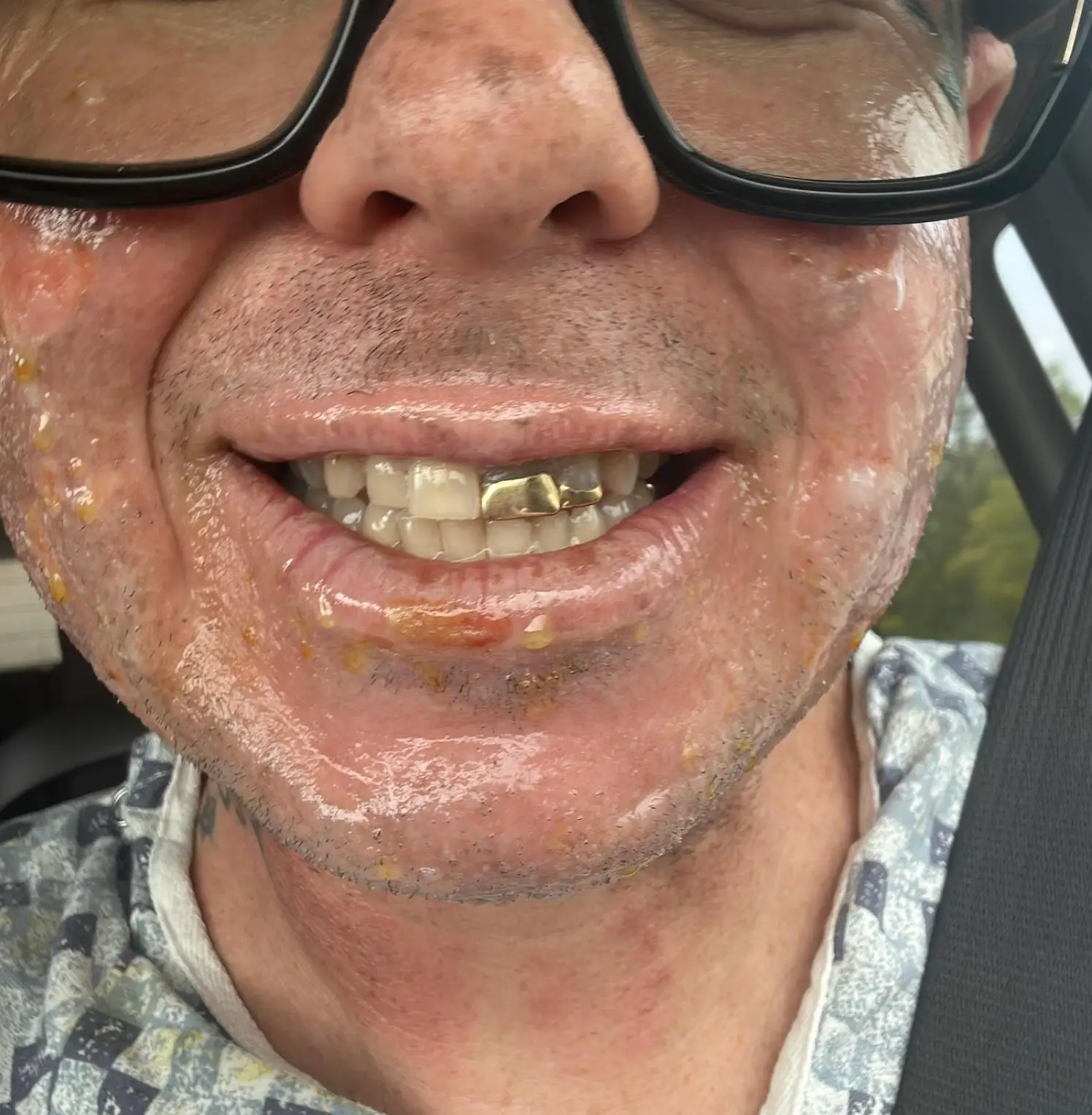 He was taken to a medical centre equipped to deal with the burns. (Instagram/@sidthe3rd)