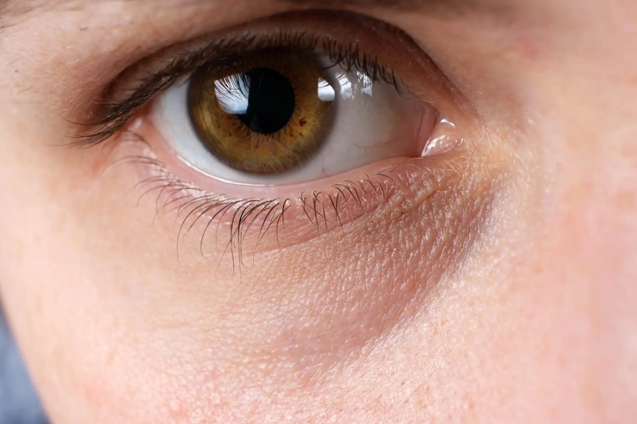 Many women have dark under eye-circles, and it may be a sign of low ferritin (Getty Stock Image)