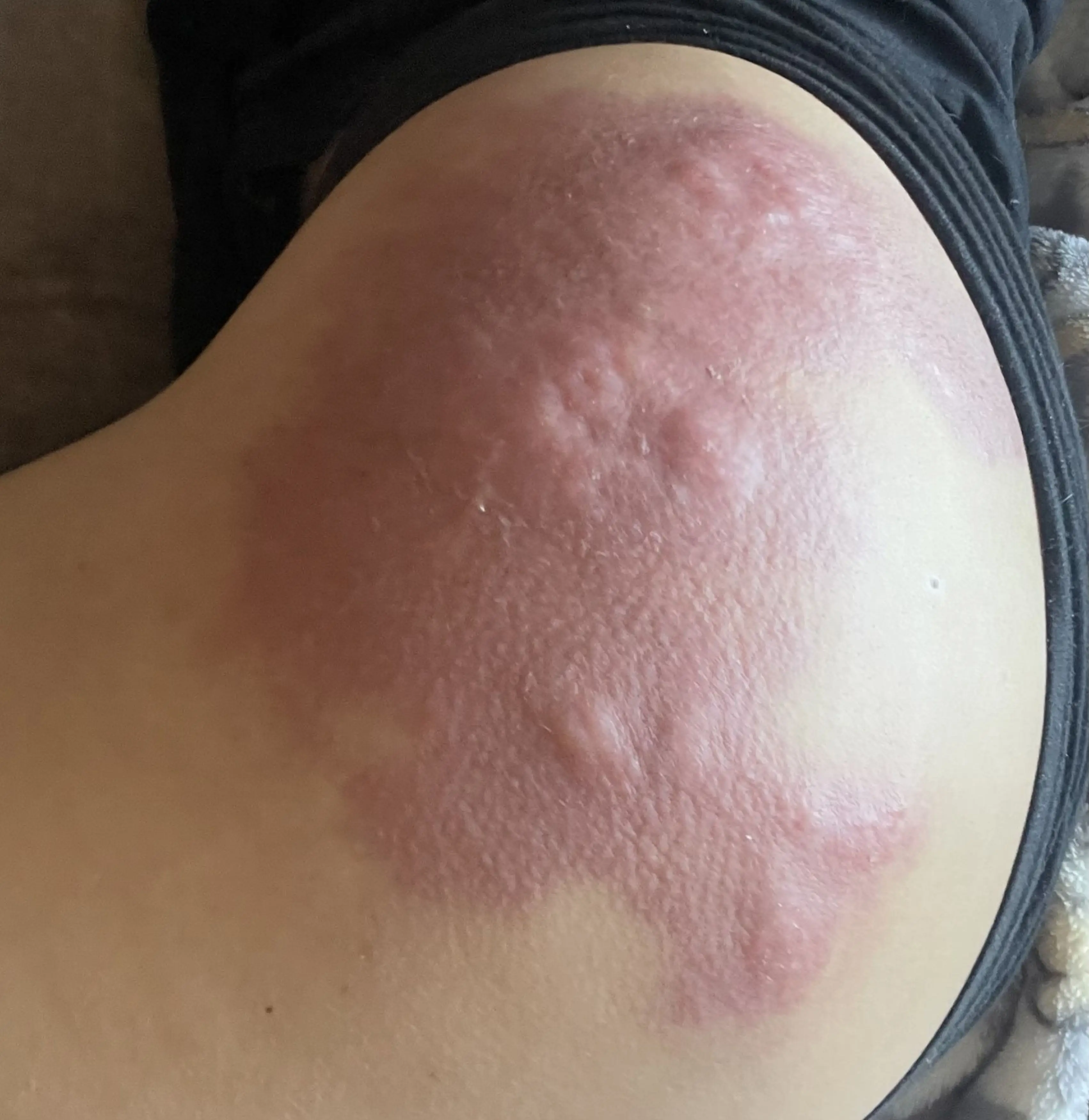 Non-dissolvable silicone was used instead of hyaluronic acid.