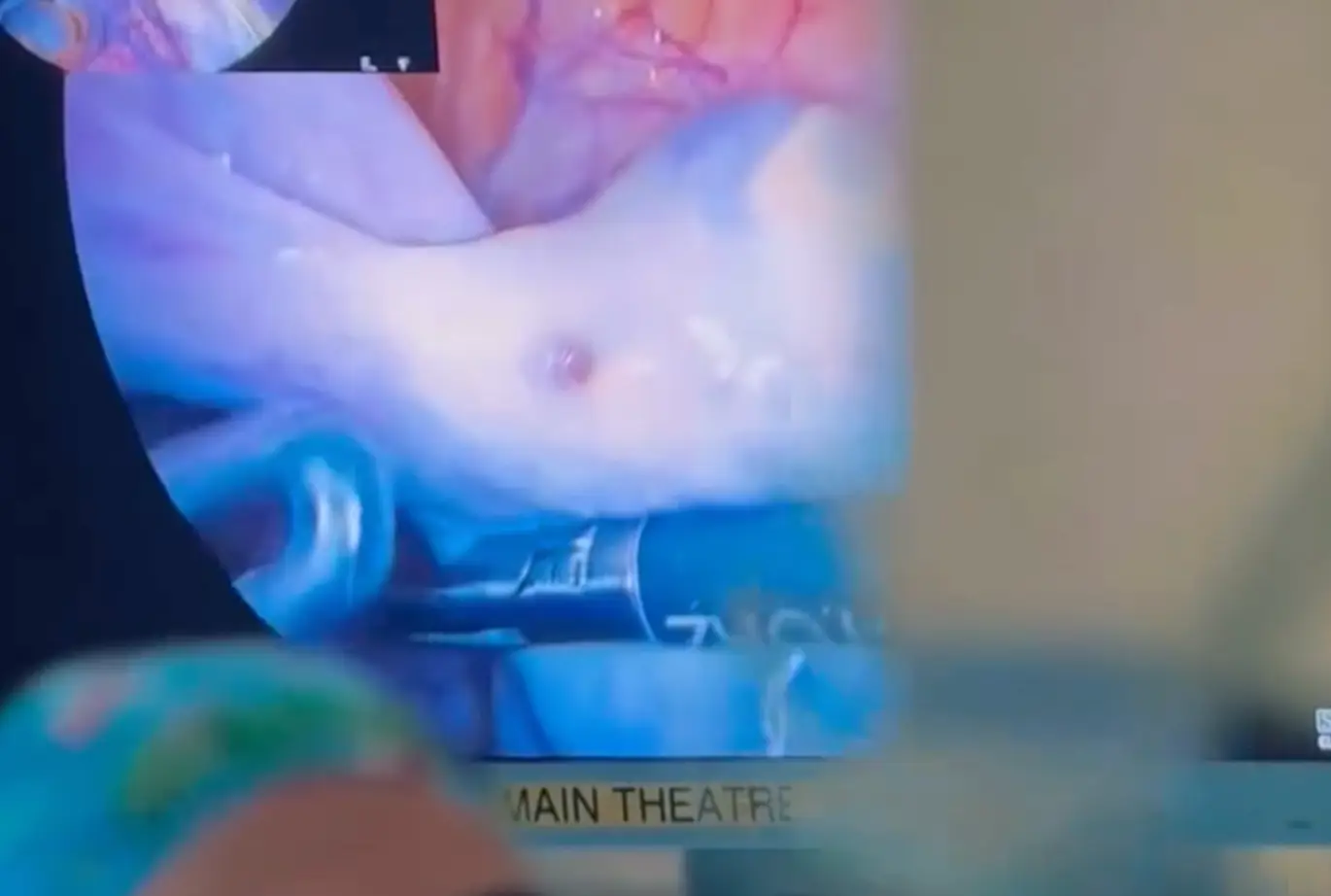 Women praised the documentary for showing real footage of what endometriosis actually looks like inside the body (BBC)