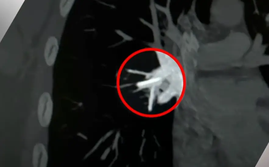 Two years ago, the now 22-year-old from Melbourne went to her local health clinic to have a common birth control procedure, in which a 4cm plastic contraceptive implant rod (Implanon) was put in to her arm.