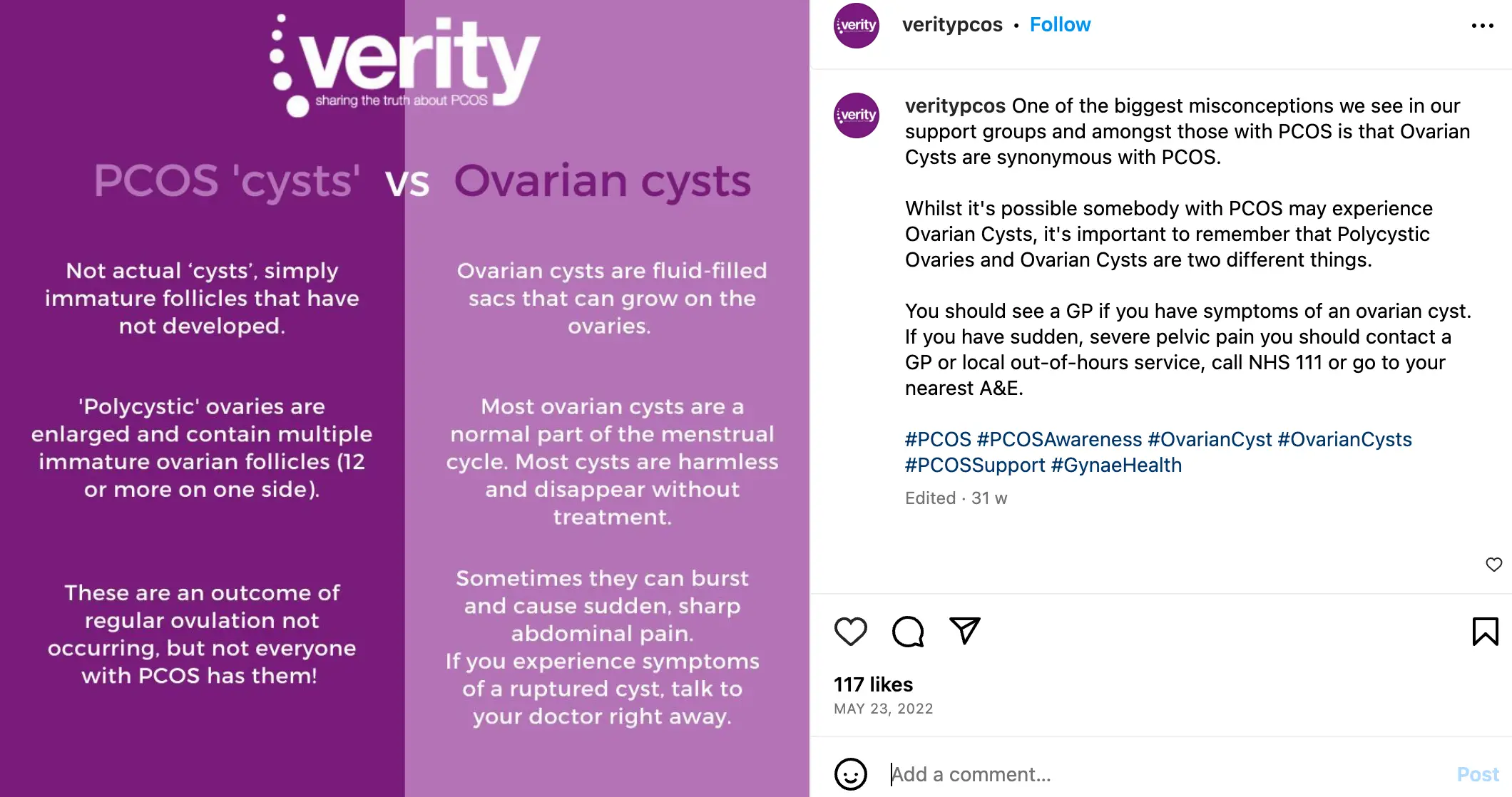 Polycystic Ovaries versus Ovarian Cysts.