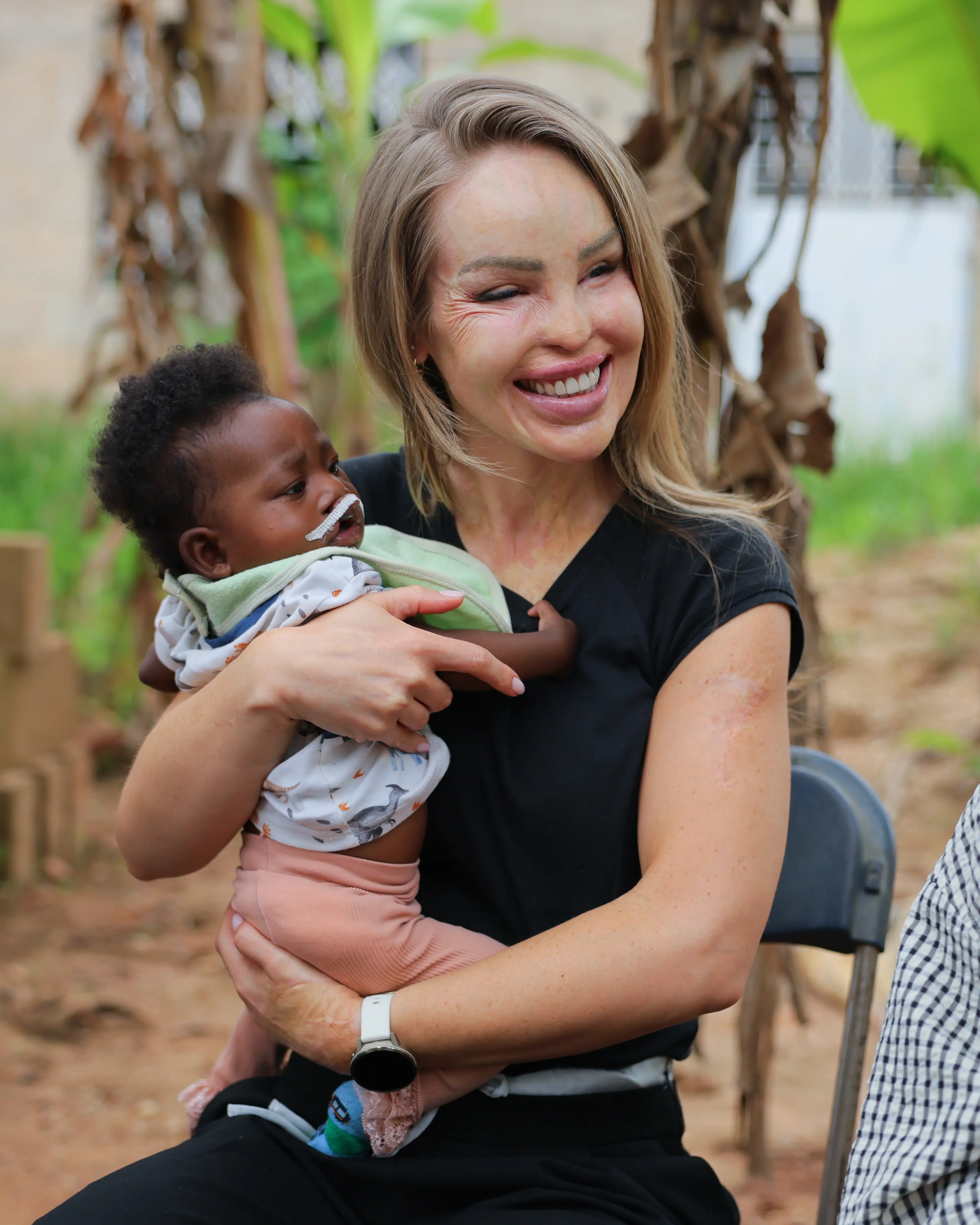 Katie is now the Global Ambassador for Smile Train, the world’s largest cleft-focused organisation (Smile Train)