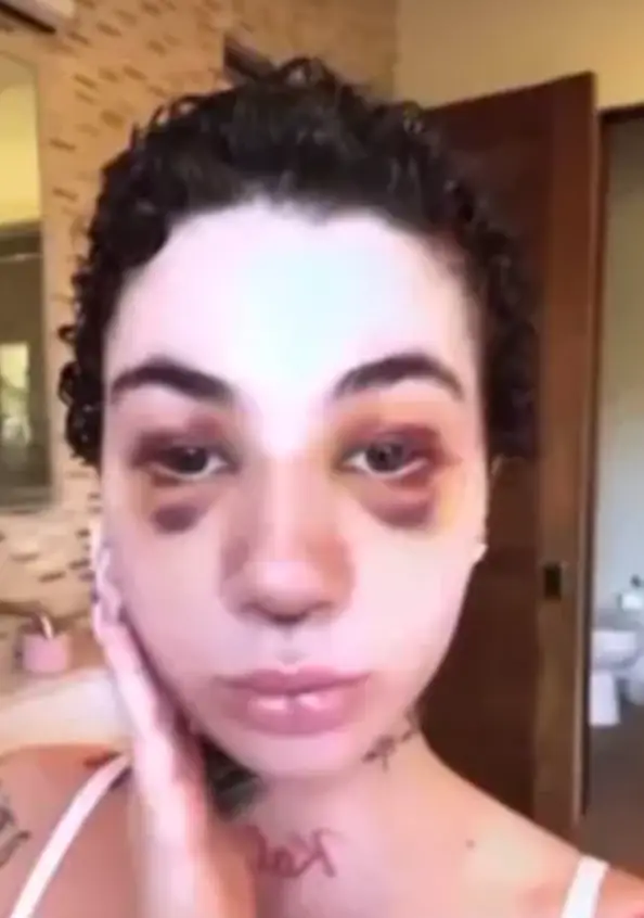 Bregoli assured fans she had been 'cleared' by her doctor to have the nose job surgery (Instagram/@bhadbhabie)
