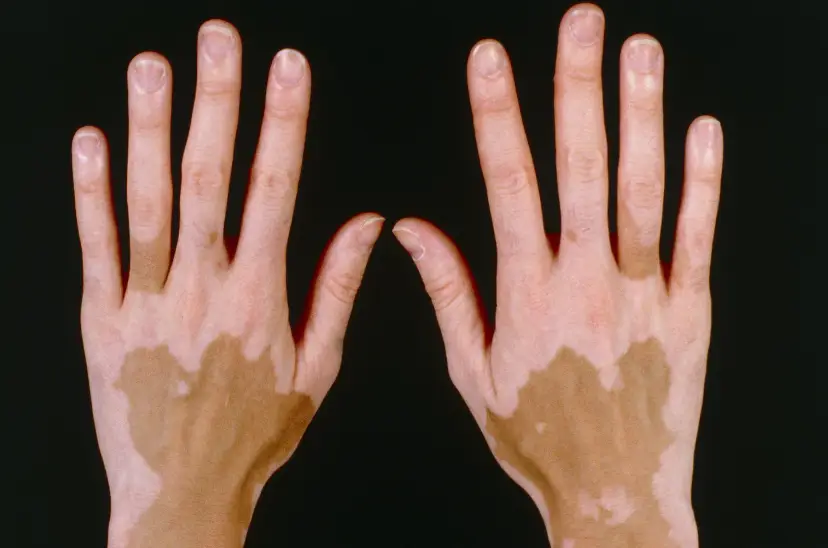 Vitiligo is a long-term skin condition. (NHS)