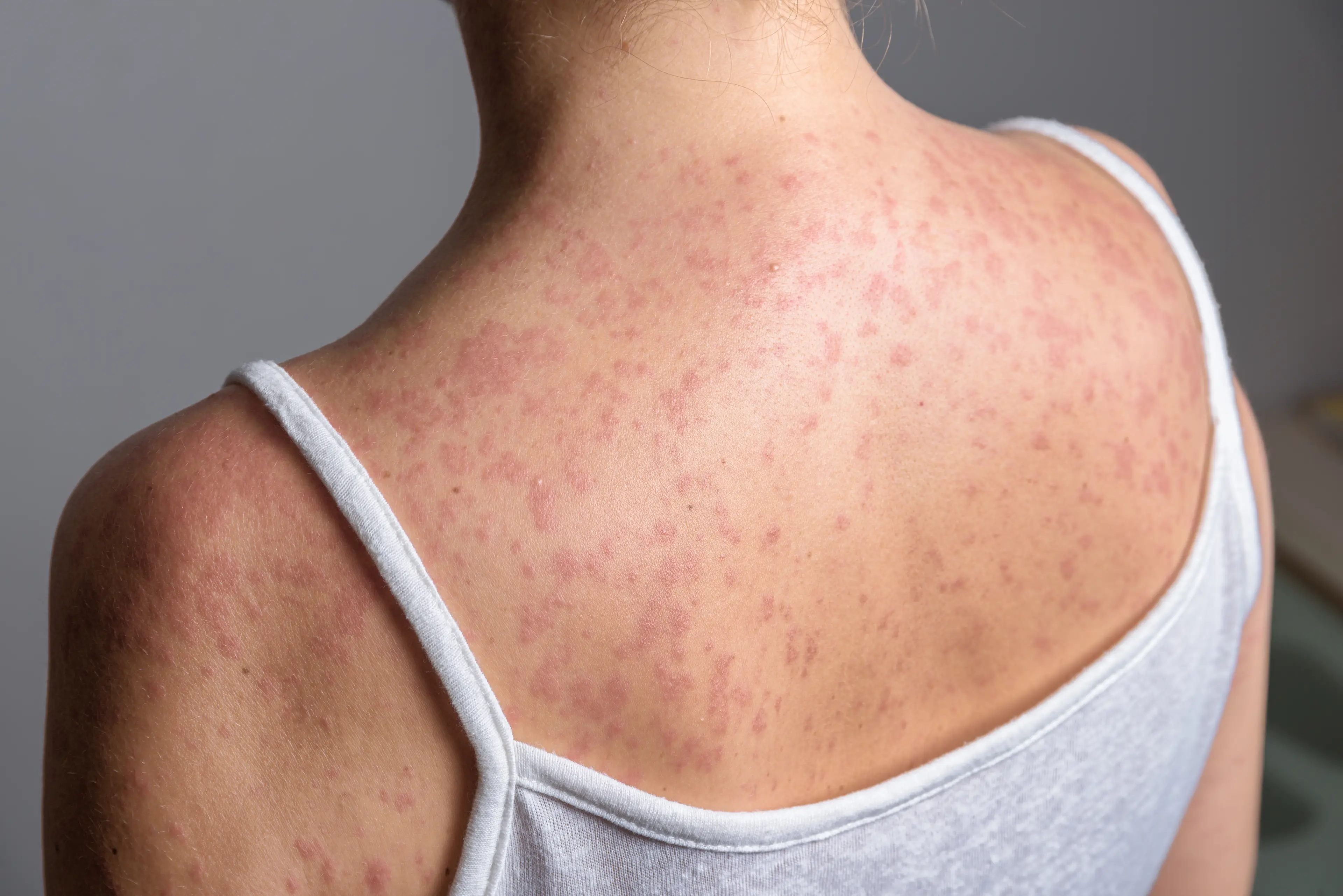 The disease can trigger a severe rash (Getty Stock Images)