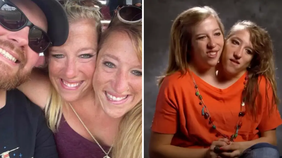 Conjoined twins Abby and Brittany Hensel would make history if one of them became pregnant
