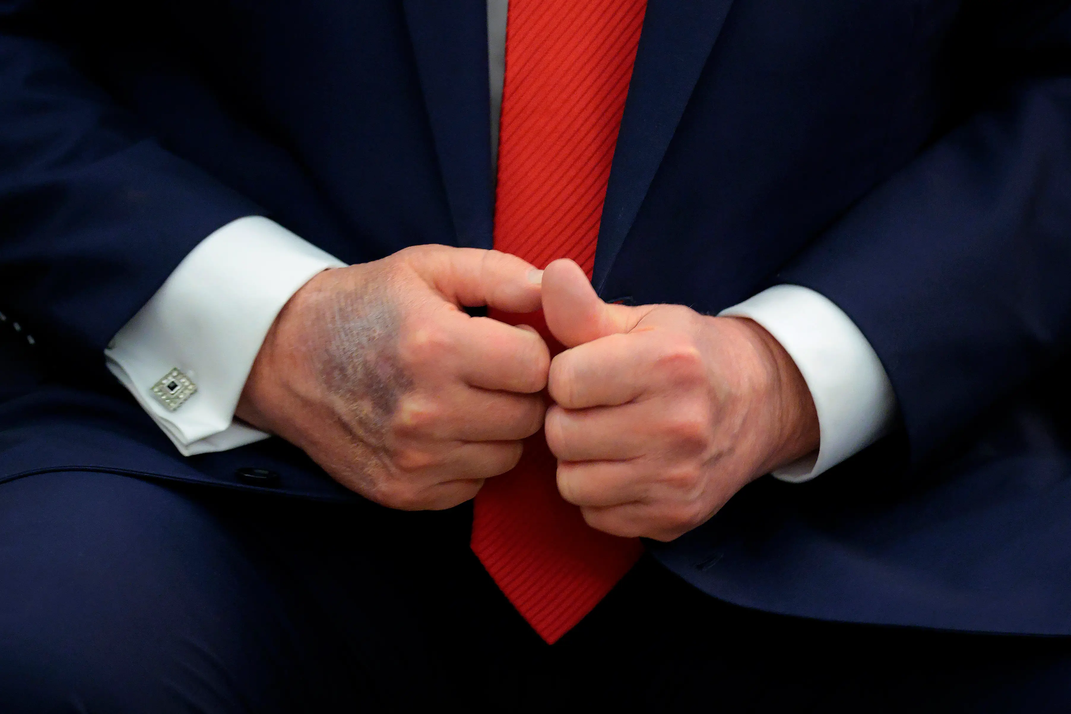 The medic addressed Trump's sporadic bruising (Chip Somodevilla/Getty Images)