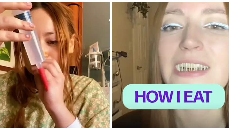 Woman Reveals What It's Like Living With Her Jaw Wired Closed