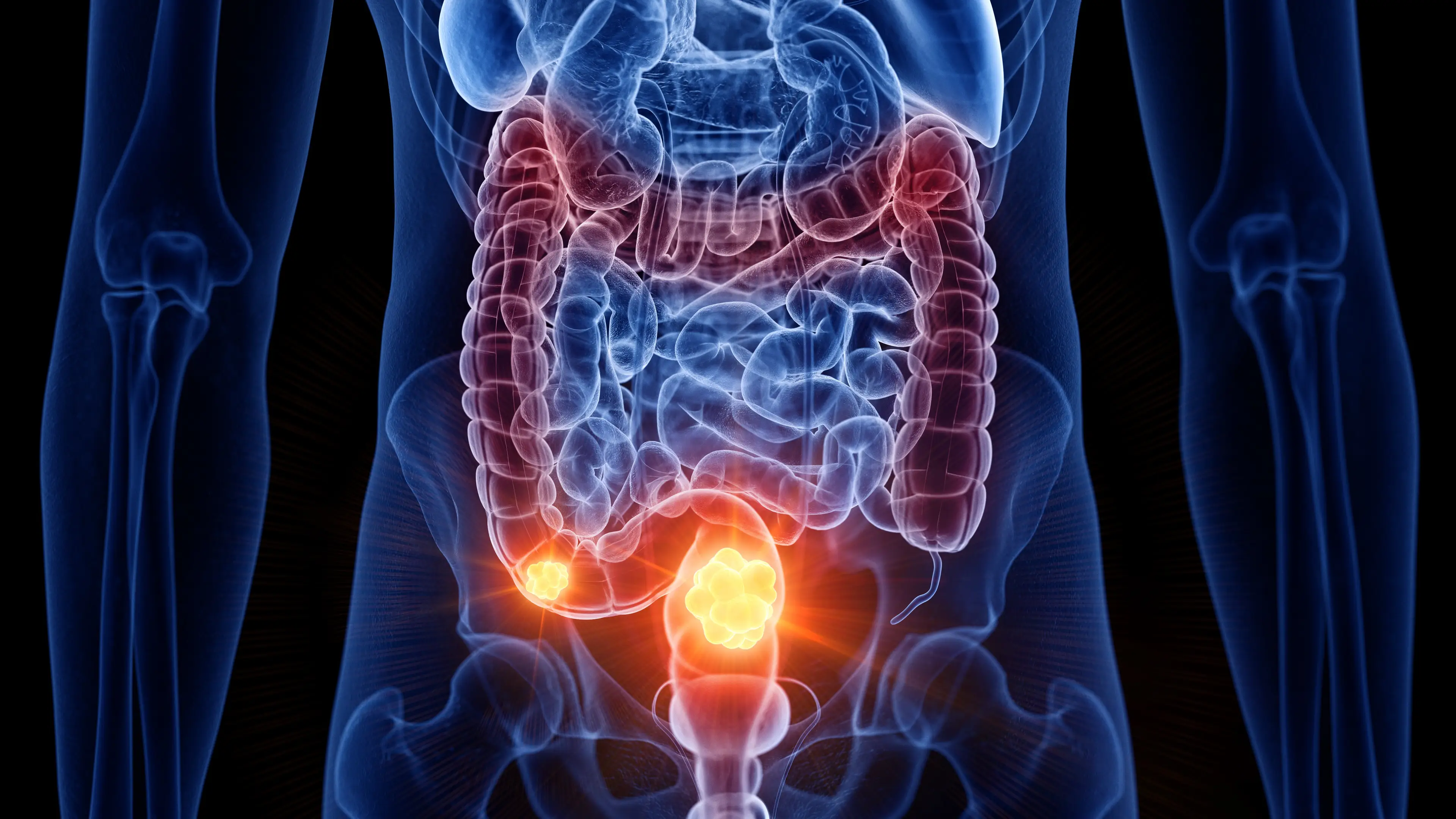 People with colon cancer are 24 times more likely to die within five years if they had one habit before diagnosis