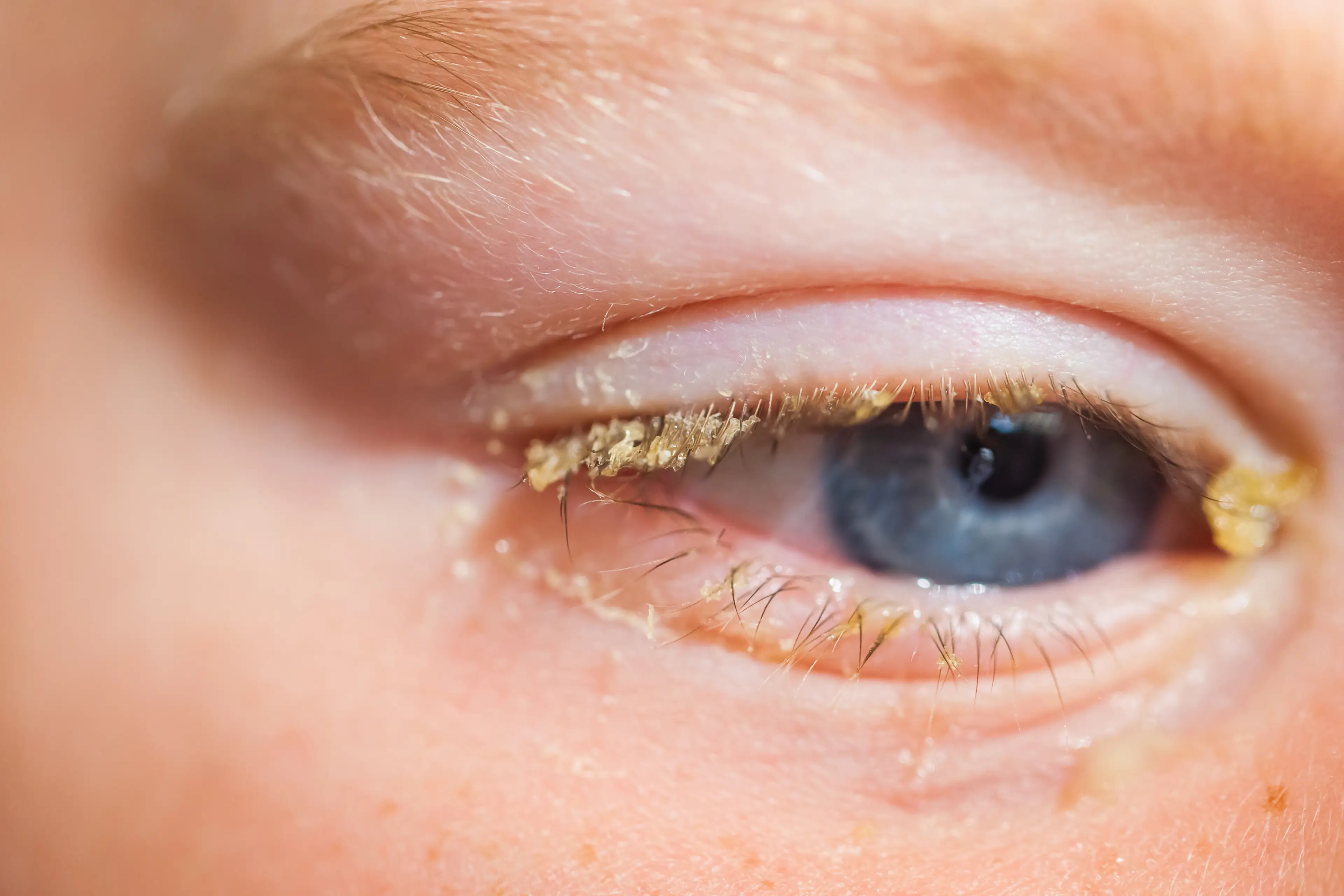 The crust you get after sleeping is actually 'dead bacteria' (Getty Stock Images)