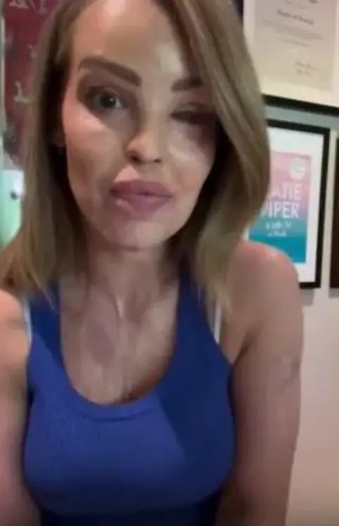 Katie Piper assured fans she was 'doing fine' in an Instagram video. (Instagram/@katiepiper_)
