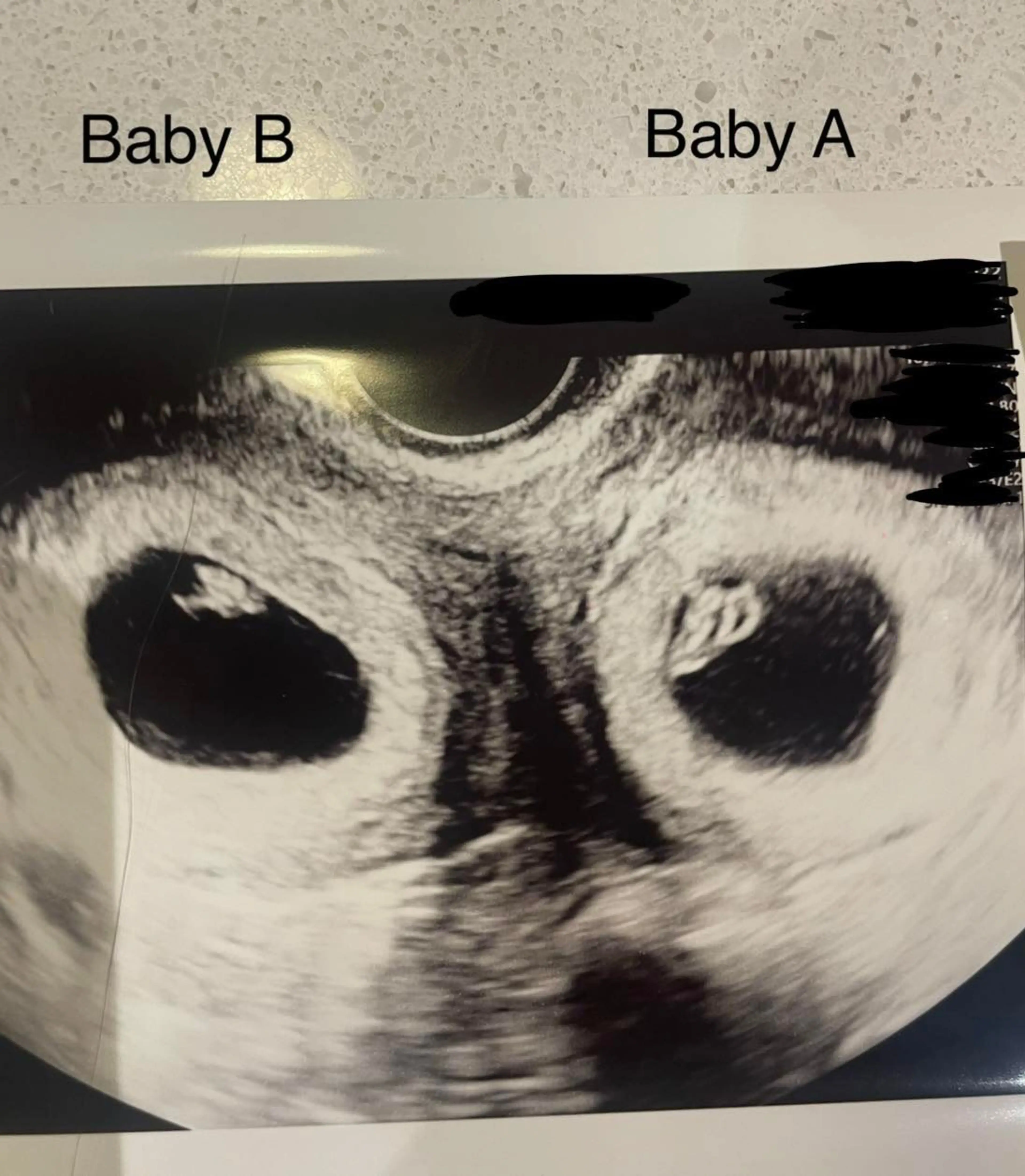 Madeline has a rare condition which means she has two uteruses