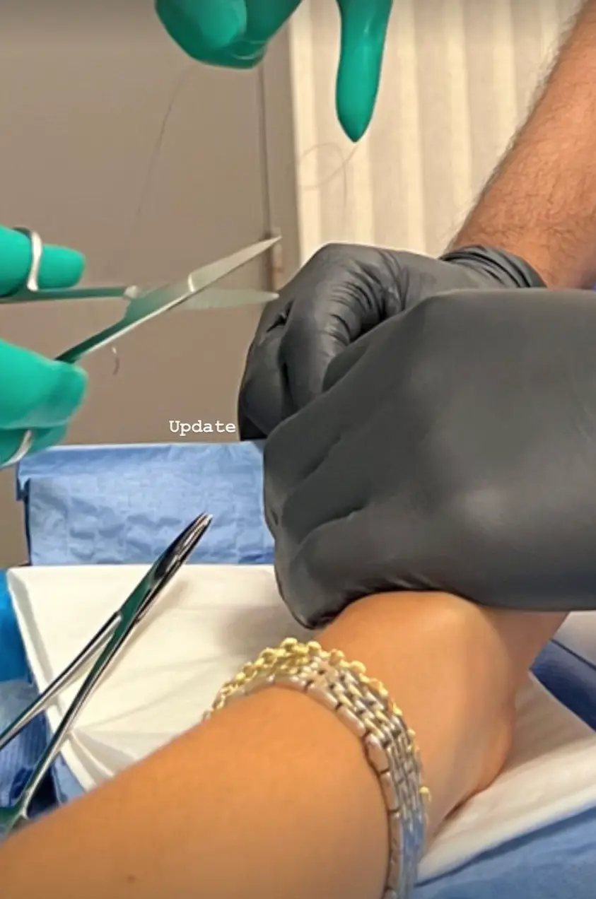 Zendaya had to have stitches.