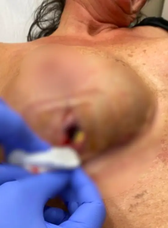 Kelly's implant was visible at the bottom of her breast.