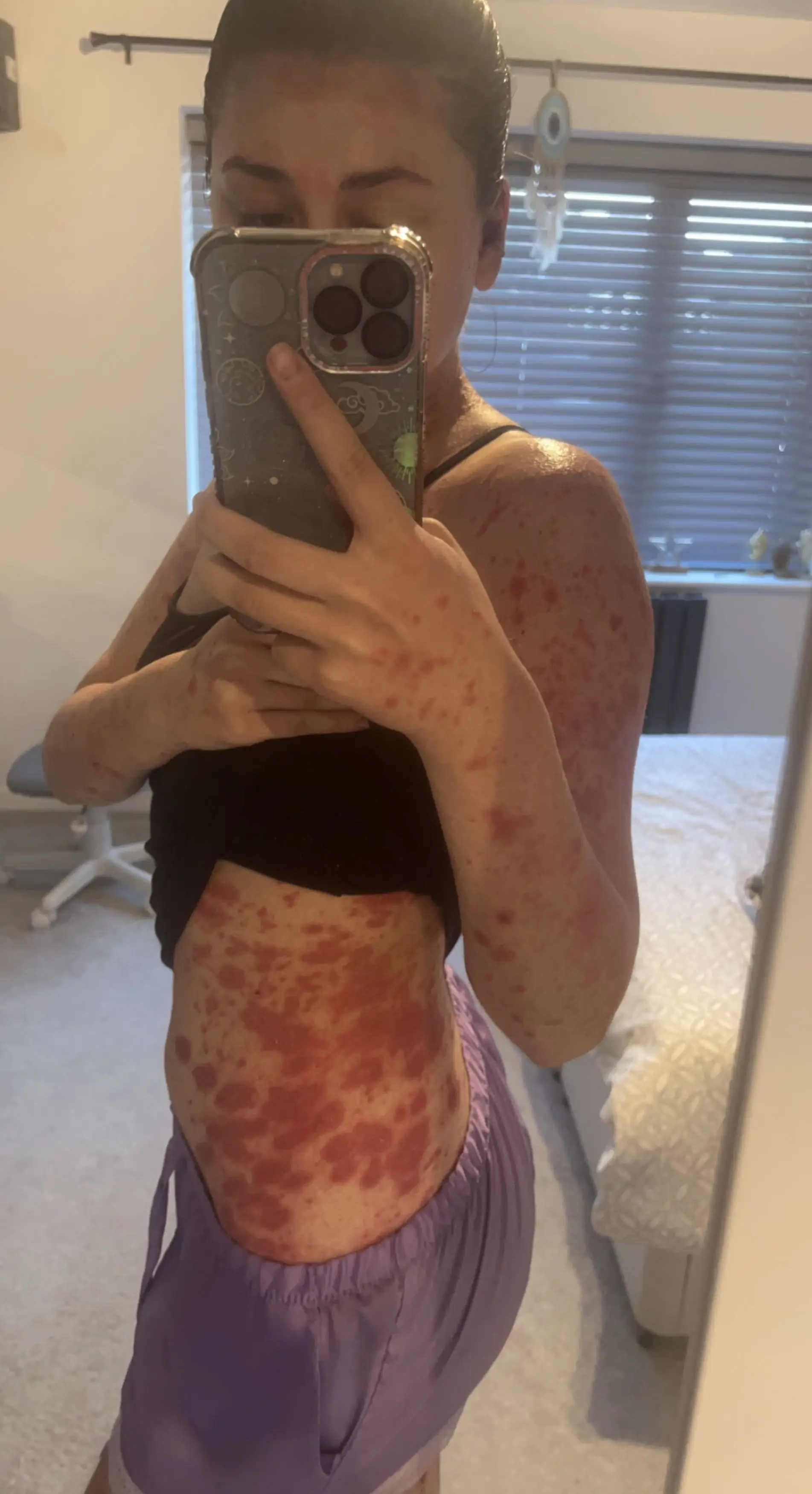 Emily's condition began by sharing vapes.