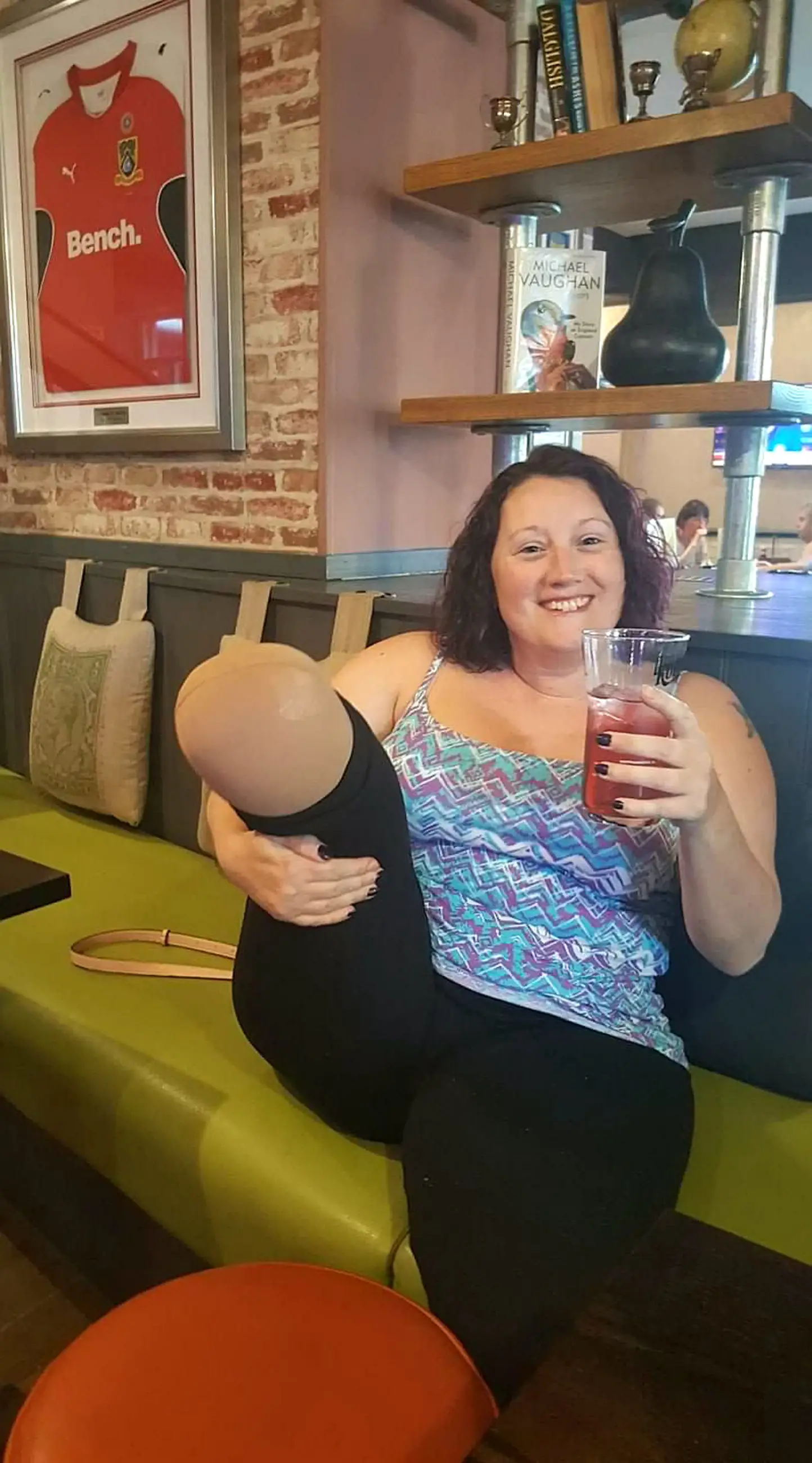 Gill Haddington had her right foot completely removed from under the knee (SWNS)