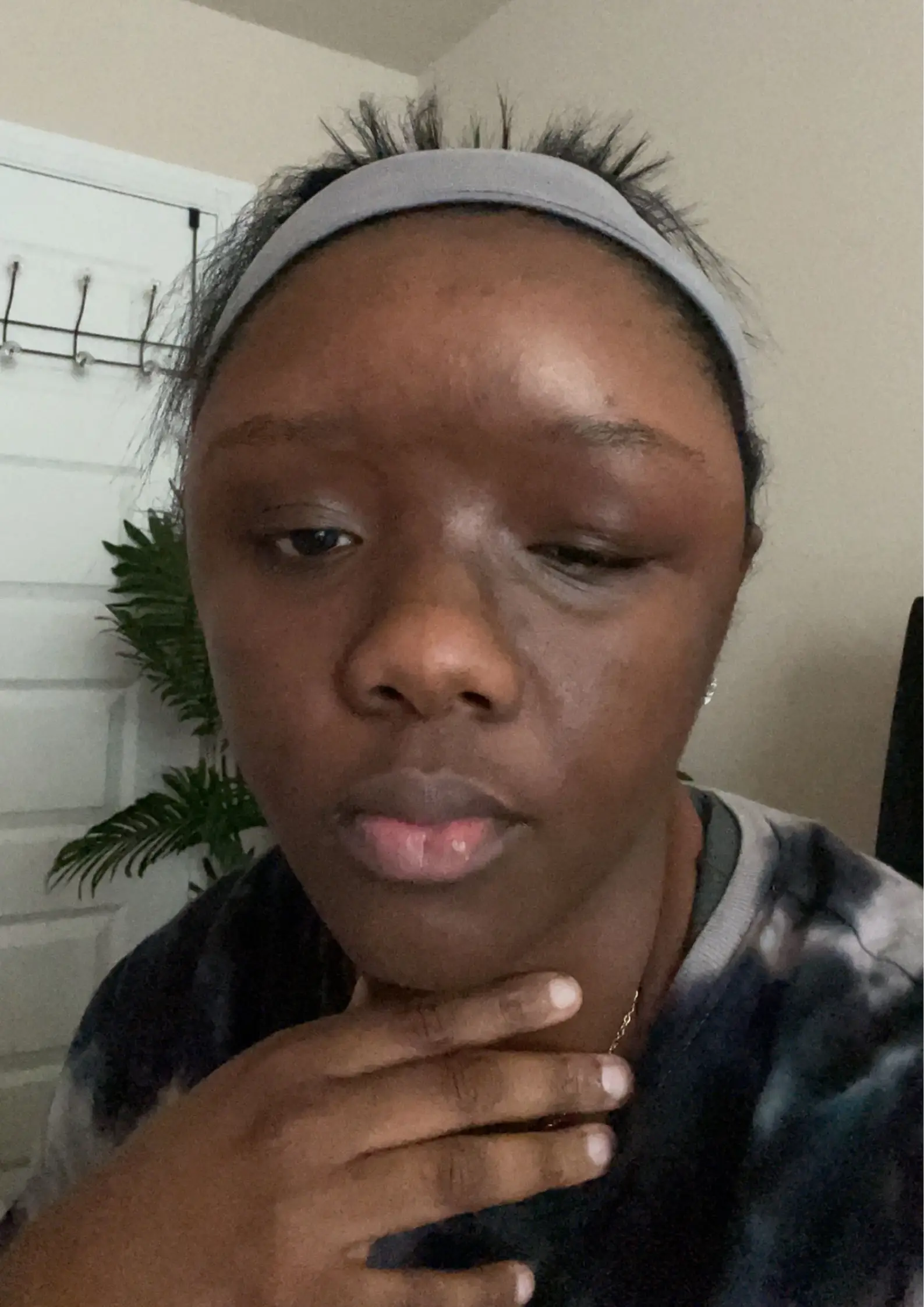 Shanika had to take time off work due to the pain caused by the reaction.