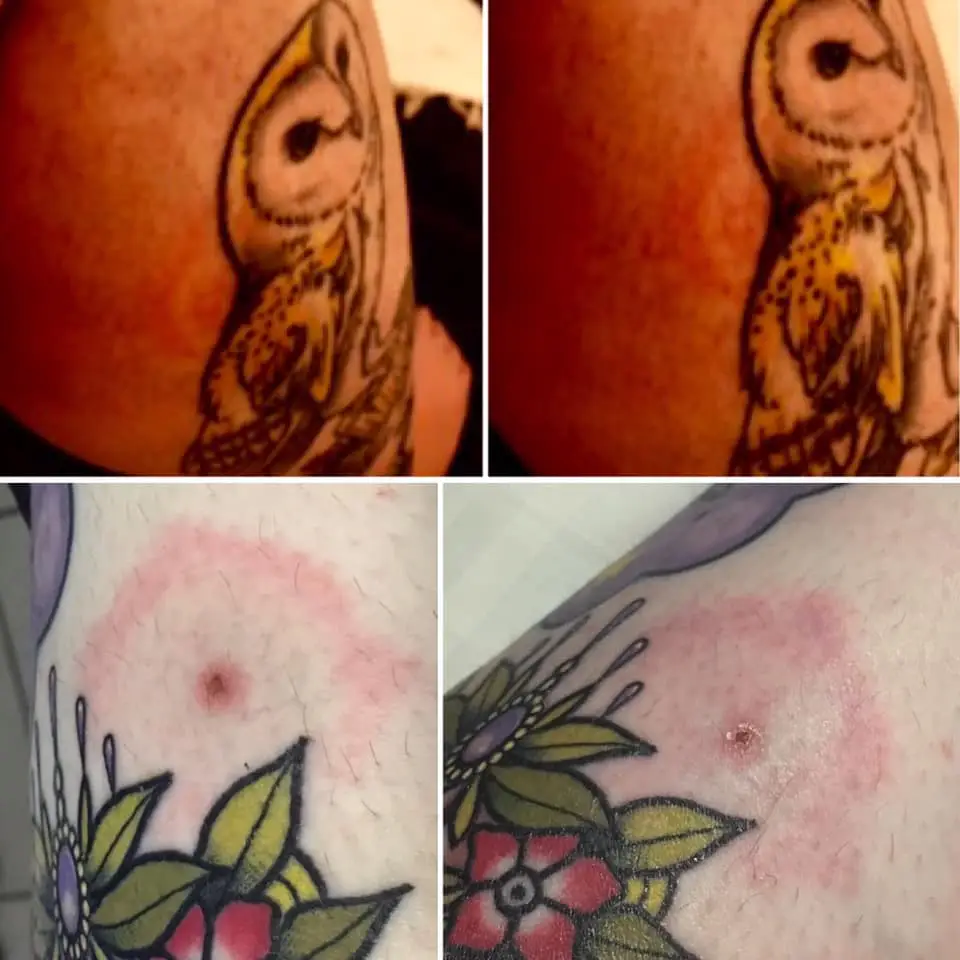 The classic 'bullseye' rash came up both times, in 2019 at a festival (top) and 2017 (bottom) after being tattooed (Jen Thomas)