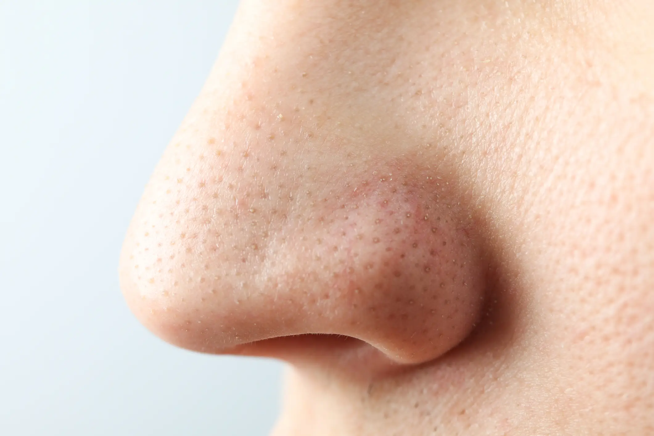 Unfortunately blackheads can affect any skin type.