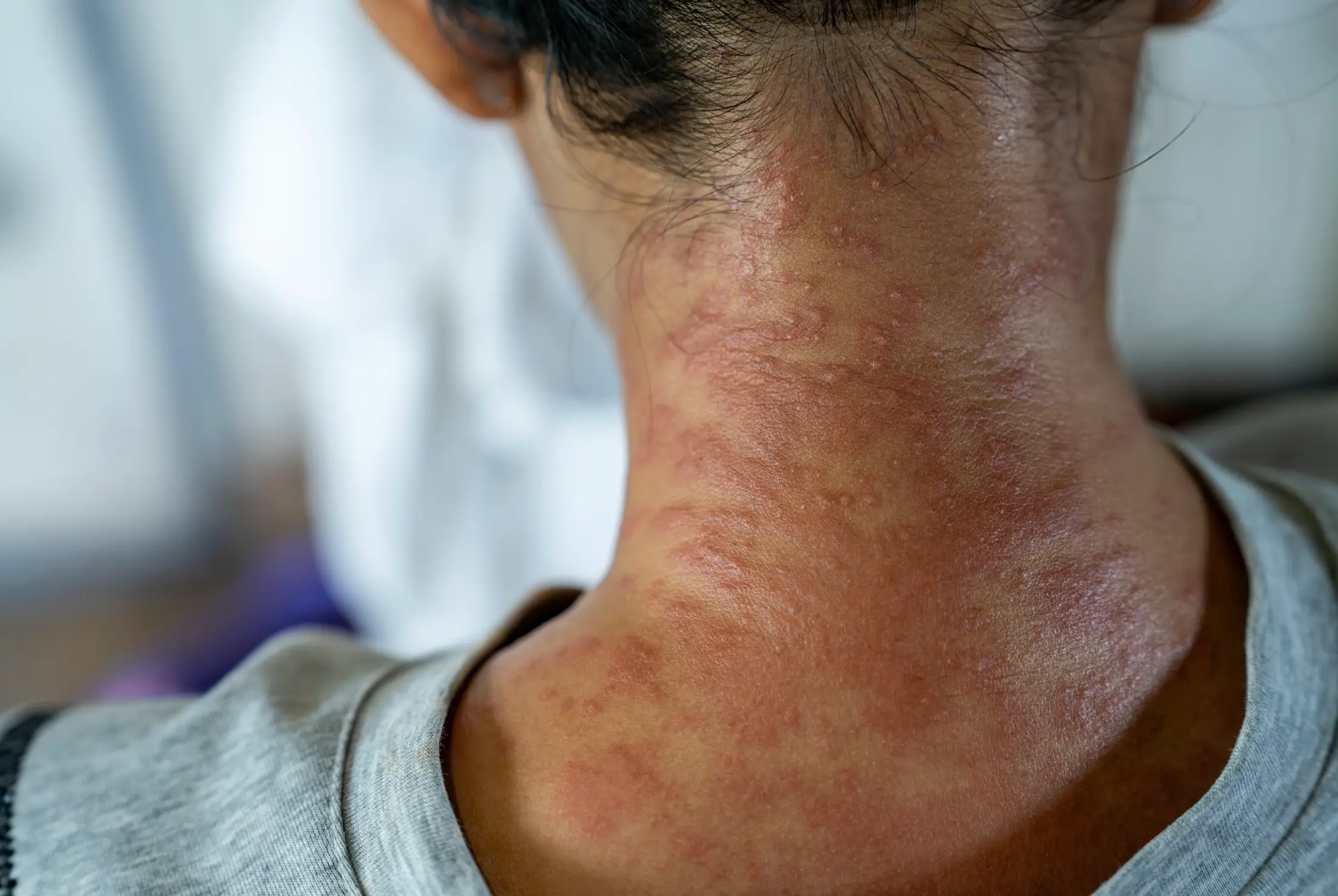 Hives or welts are another red flag indicator (Getty Stock Image)