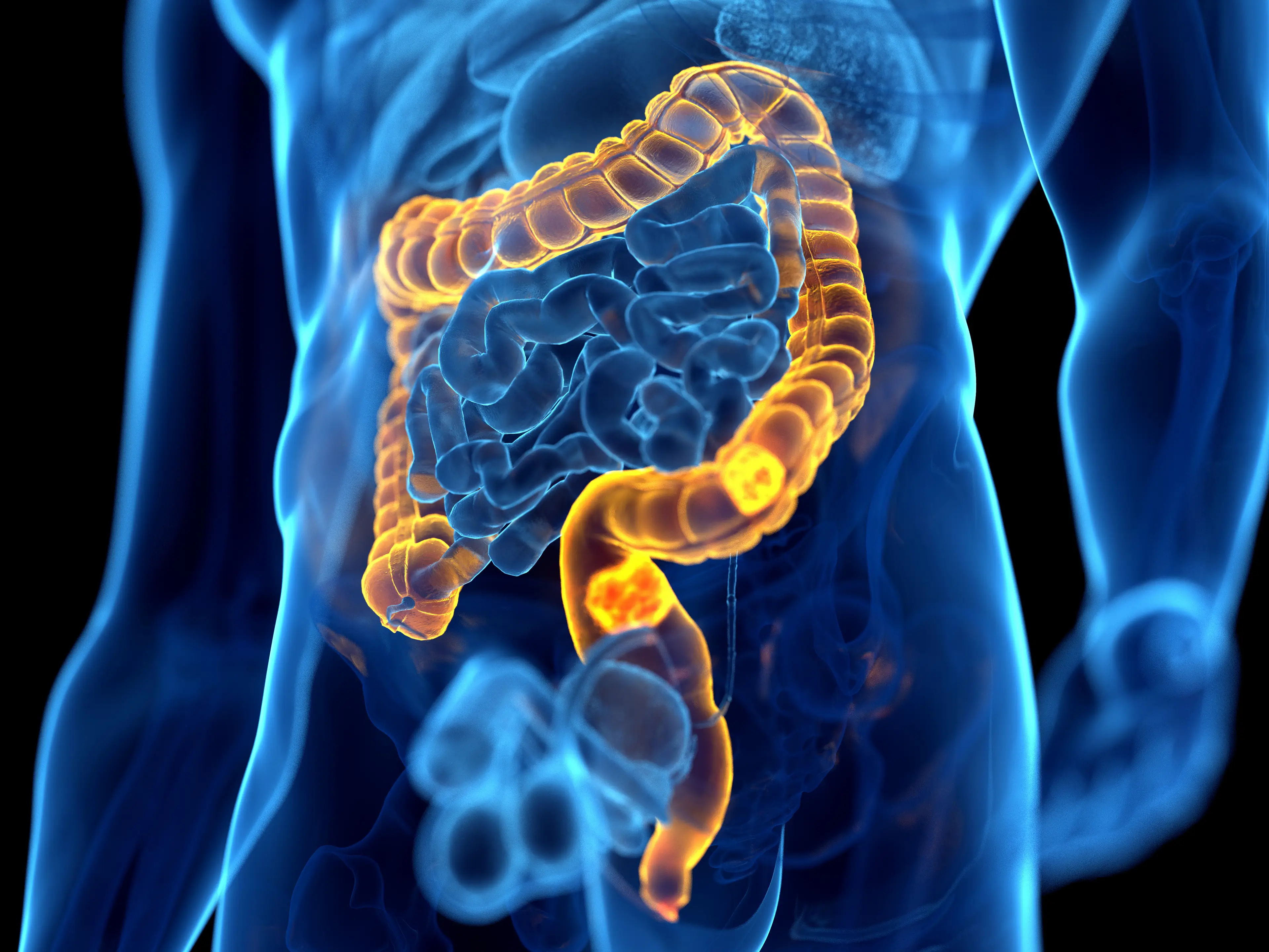 Colon cancer is on the rise in young people. (Getty stock images)