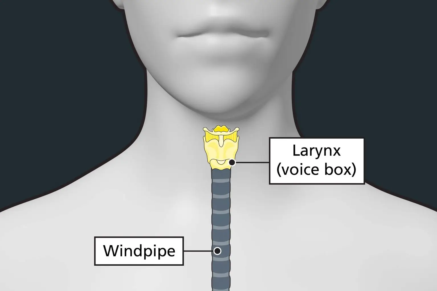 Laryngeal cancer is a type of throat cancer that affects the voice box (larynx) (NHS)