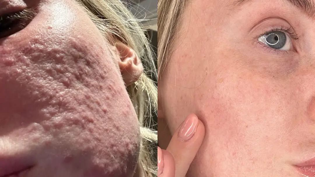 Viral silver mask that ‘kills’ breakouts is hailed as ‘life-changing’