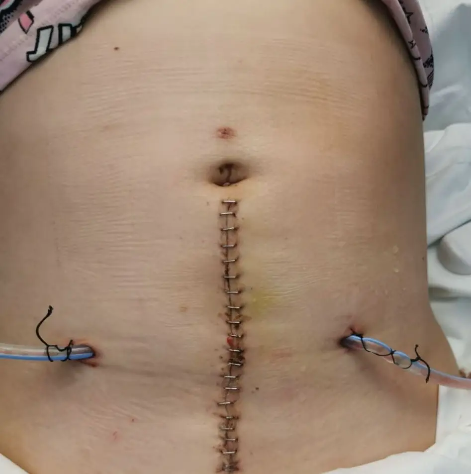 Lucy was rushed into emergency surgery in 2019 (PA Real Life)