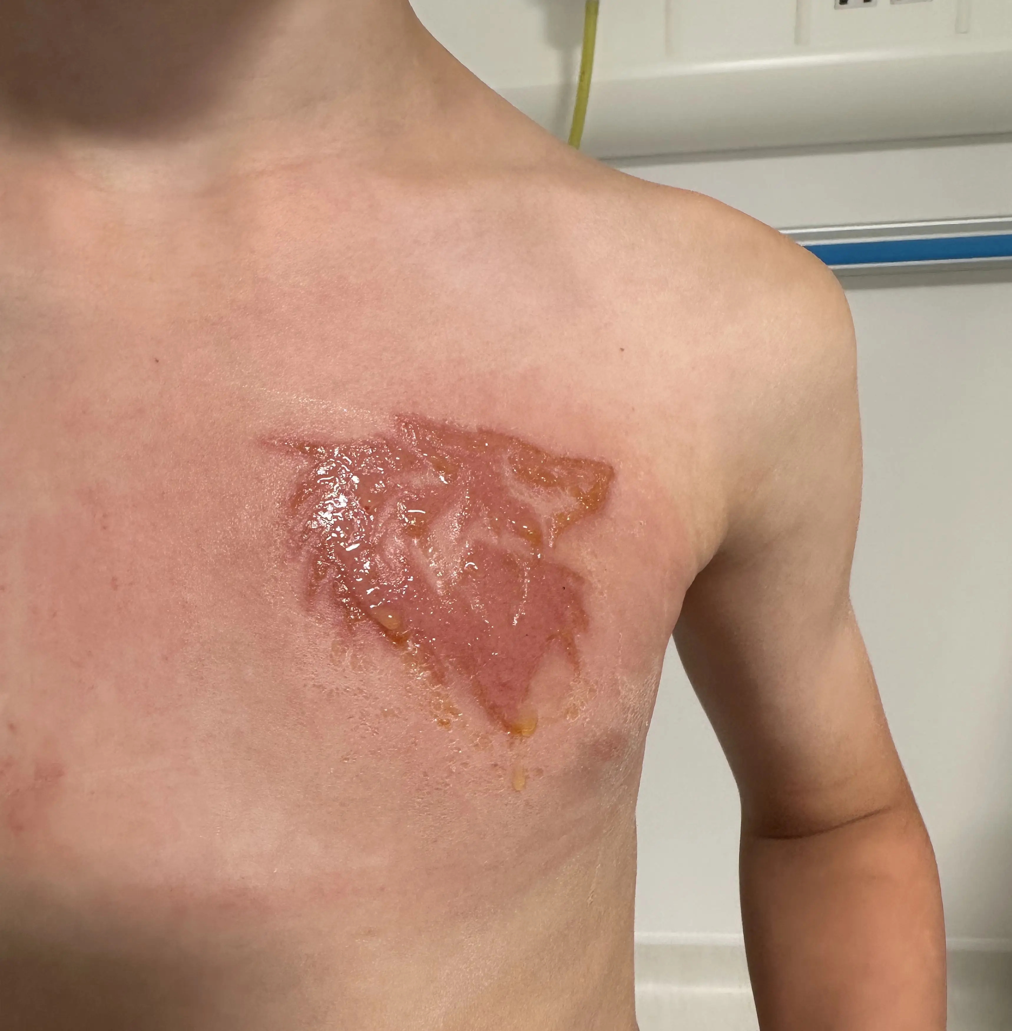 The youngster was left with chemical burns.