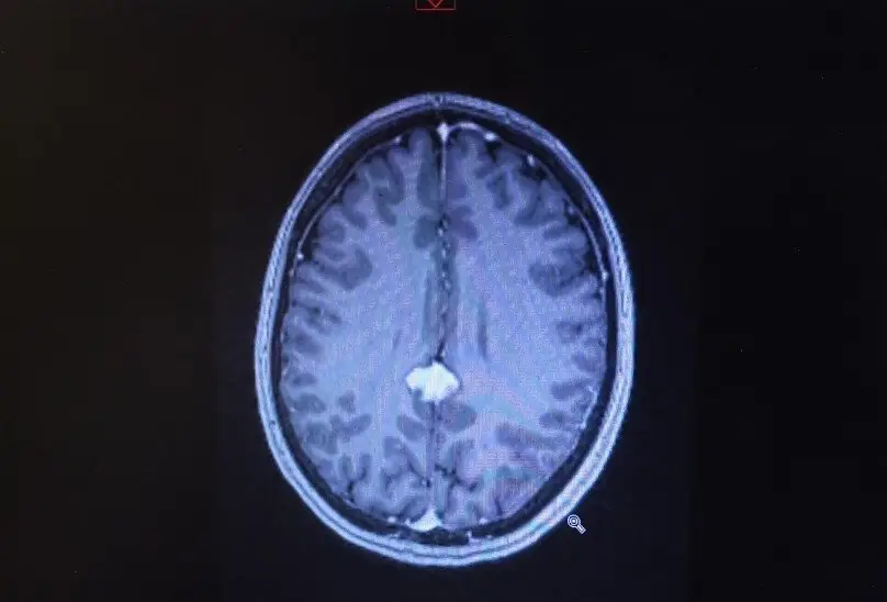 April's tumour has since shrunk (SWNS)