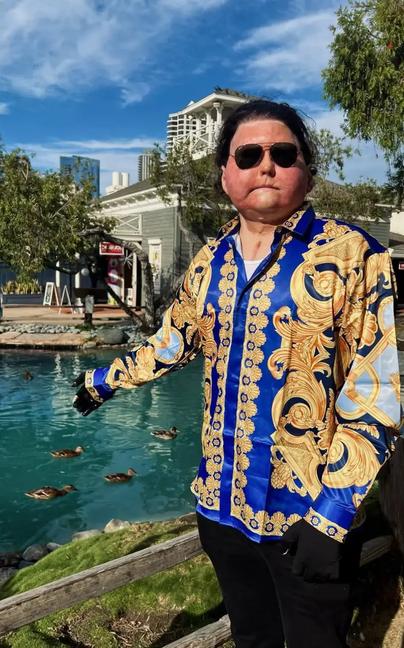 Joe was only 18 when he got into a horrific car crush, sustaining burns on most of his body. (Instagram/@joeroydimeo)