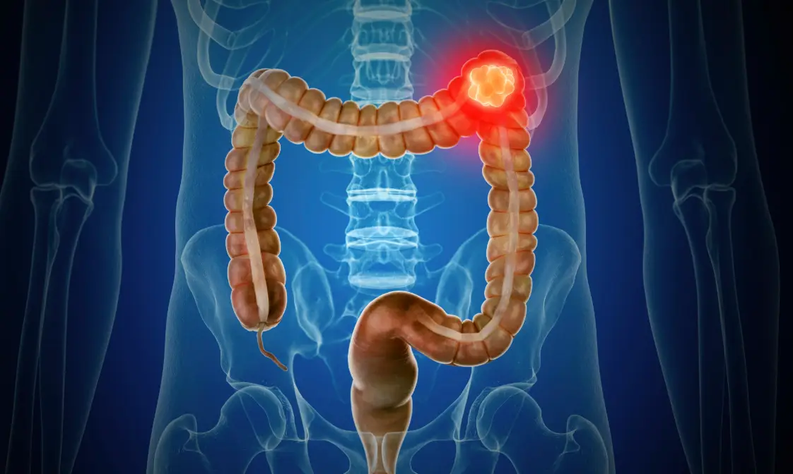 Bowel cancer cases are at an all-time high (Getty Stock Image)