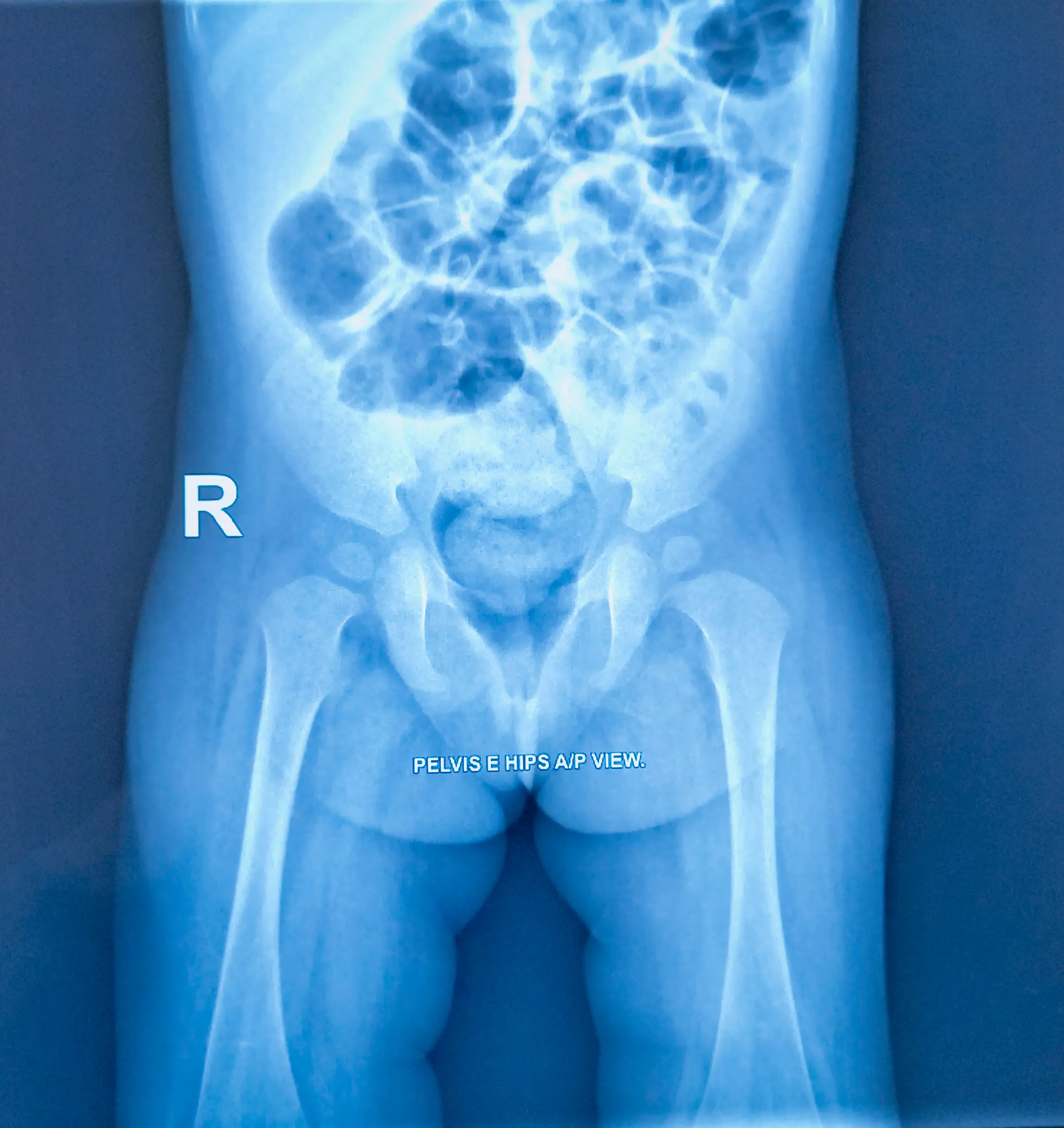 The man had a prolapsed rectum - aka, his rectum fell out (Getty Stock Images)