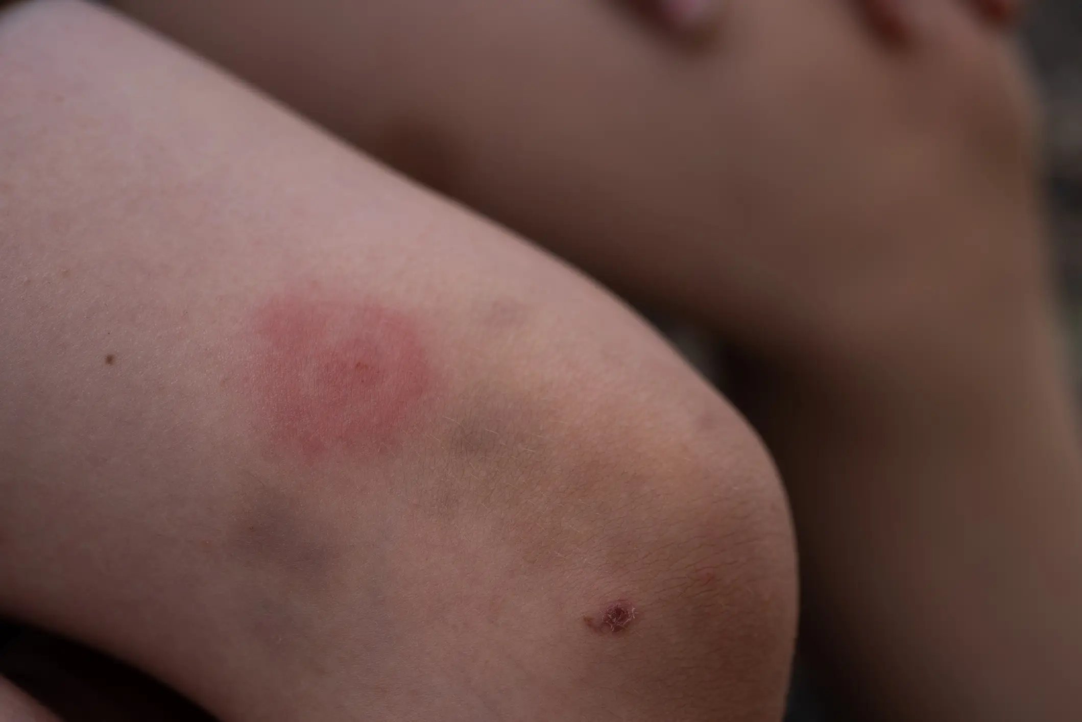 A 'bullseye' type rash can emerge following the infection (Getty Stock Images)