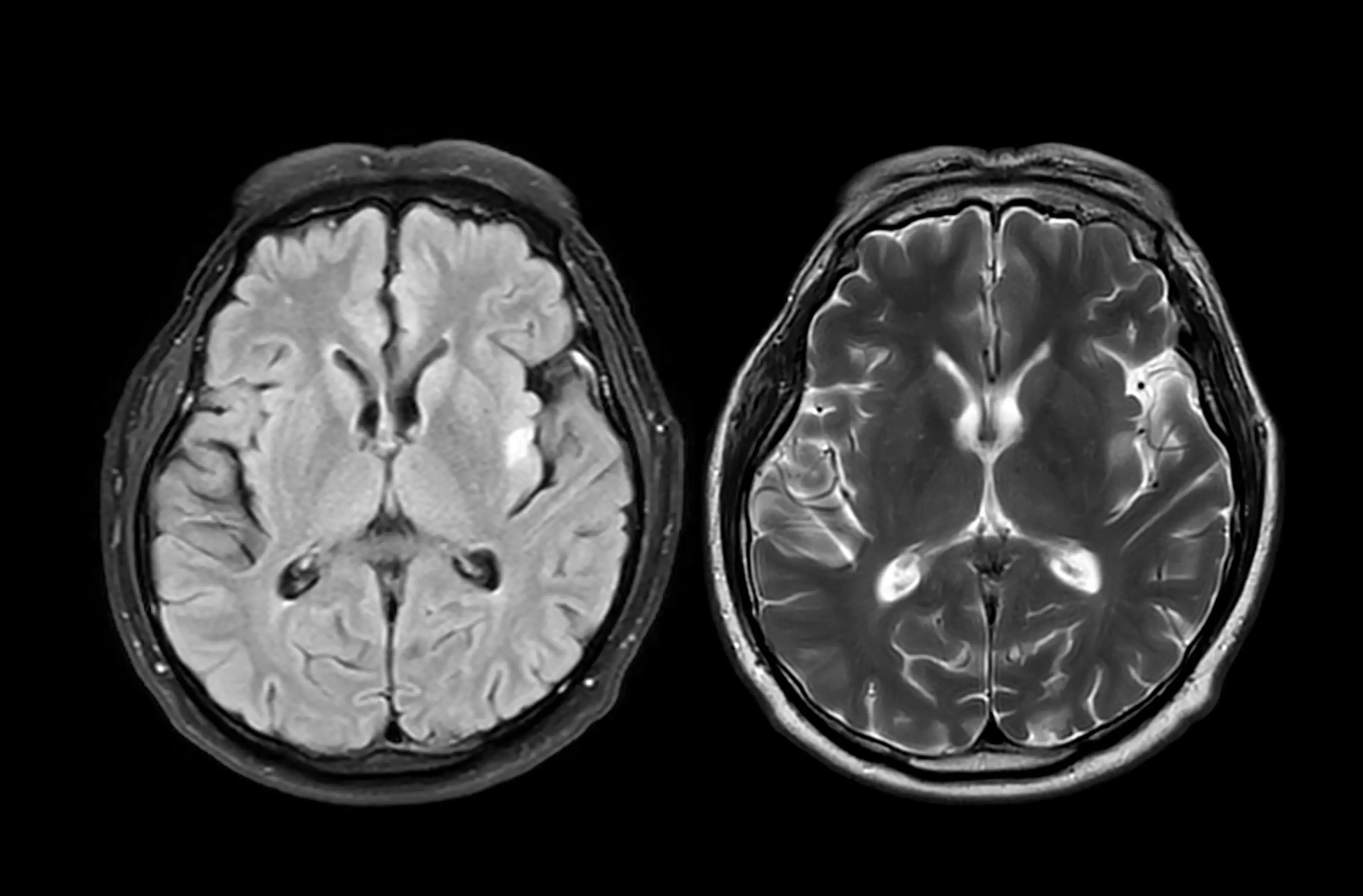 Memory loss is not the only symptom you need to be aware of (Getty Stock Image)