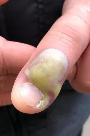 Nail biters - listen up! (Facebook/Karen Peat)