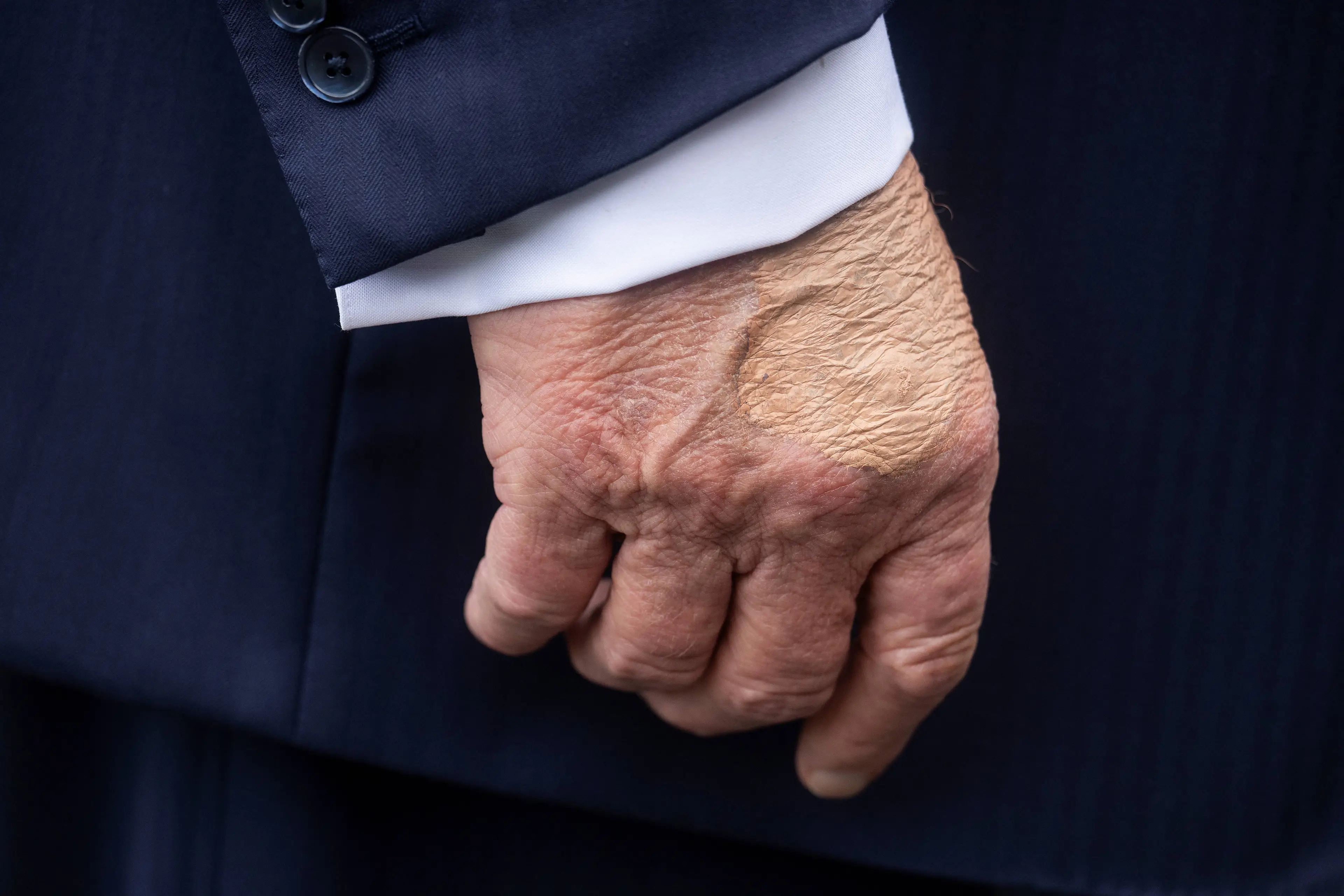 Trump's bruised hand has also caused a stir (JIM WATSON / Contributor / Getty Images)