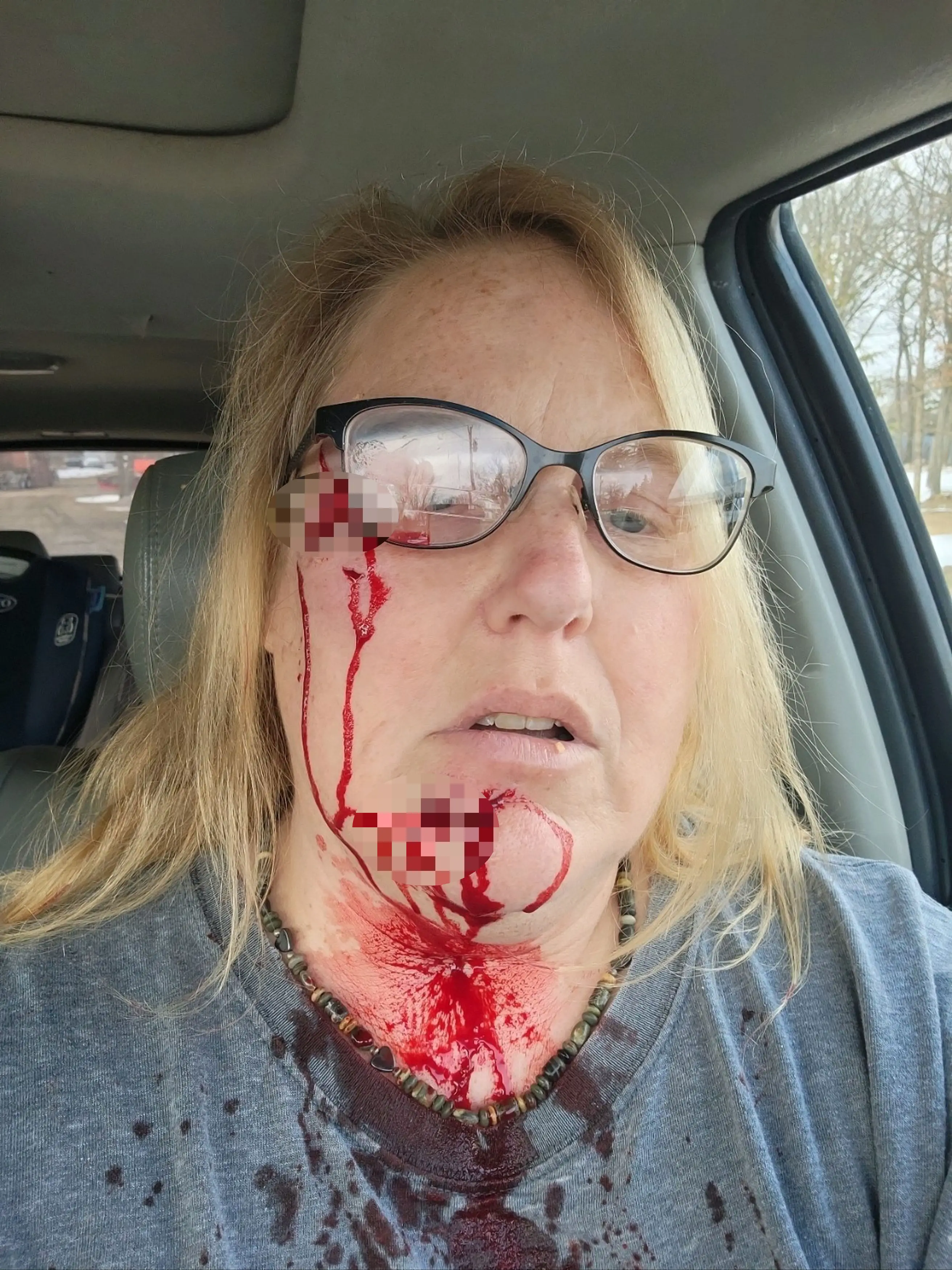 After fighting off the pitbull, Rhonda drove herself to hospital.