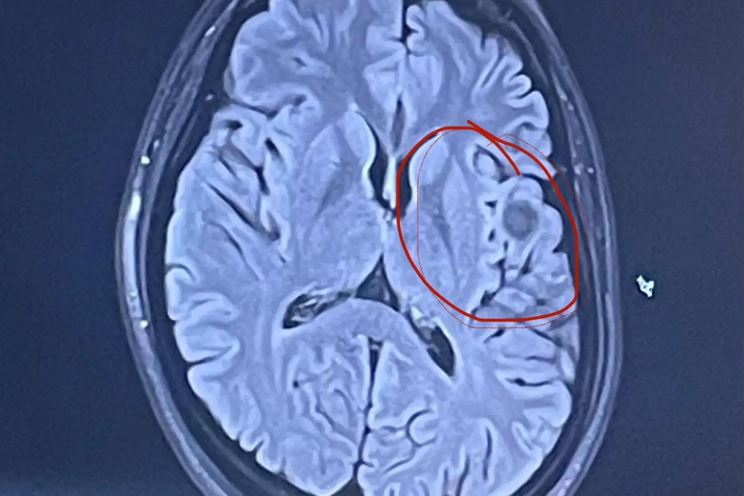 She was diagnosed with a non-cancerous cavernoma (SWNS)