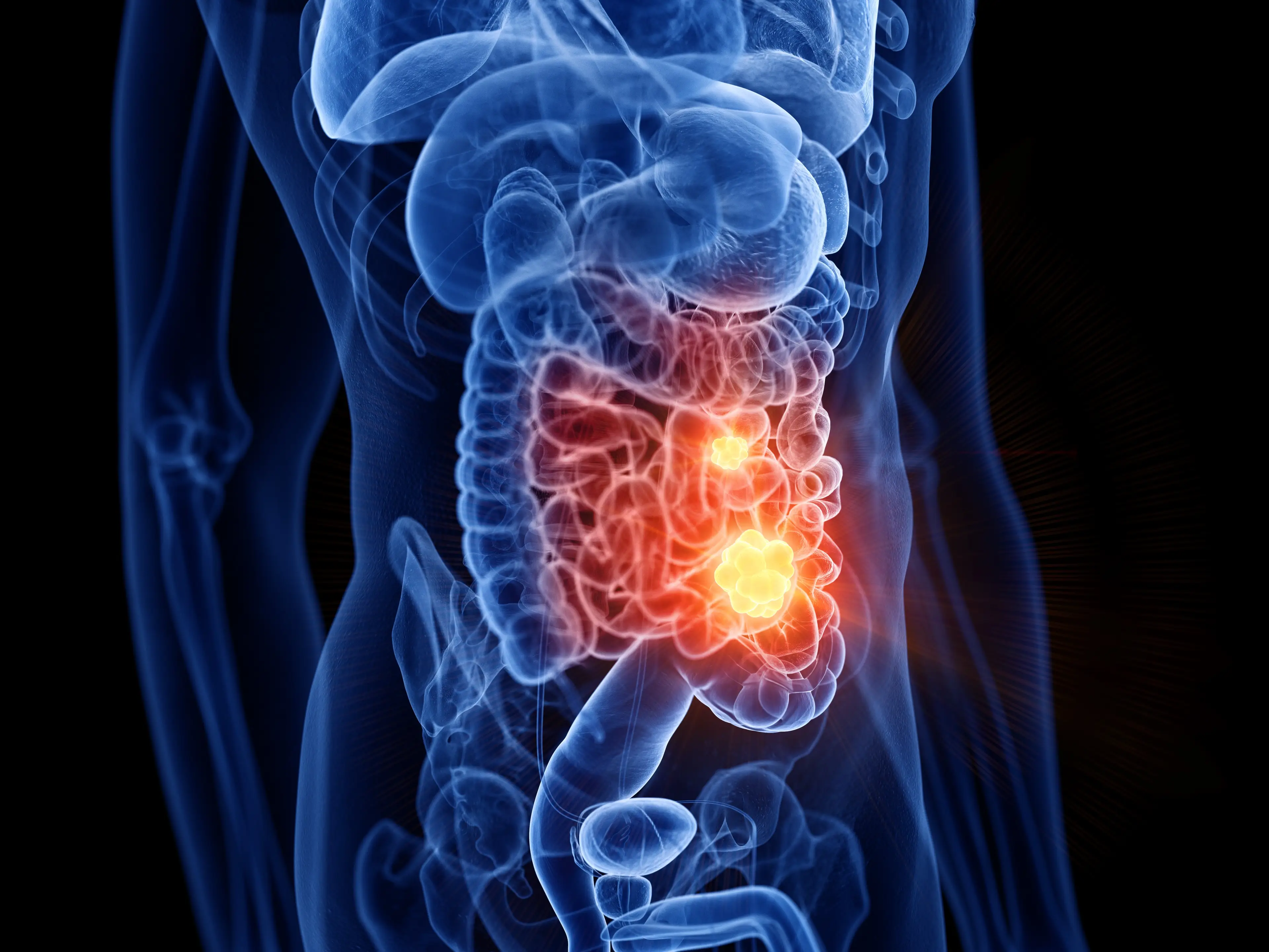 New scientific research has revealed why we could be seeing more bowel cancer cases among young women (Getty Stock Image)