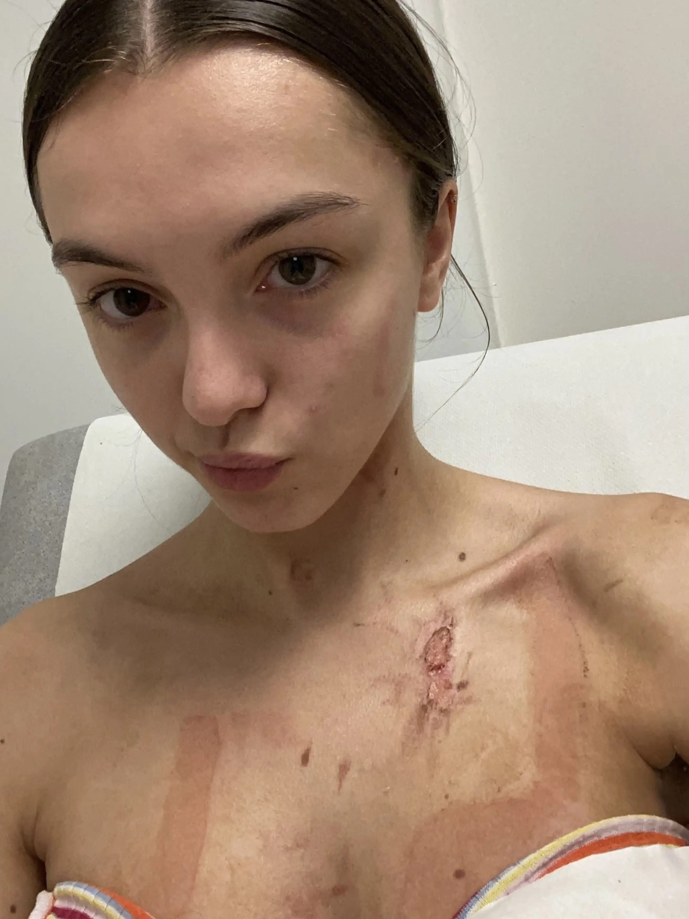 She's now warning others to be careful in the kitchen. (Kennedy News and Media)