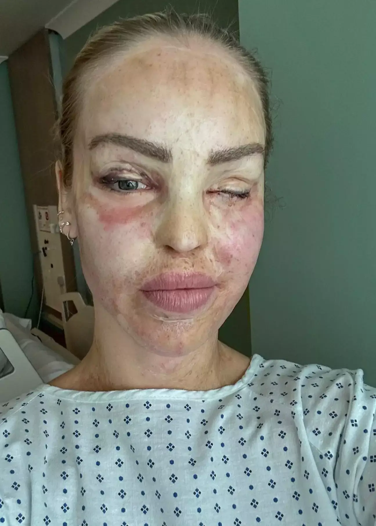 Katie Piper has had her eye sewn shut to help 'preserve' her eye.
