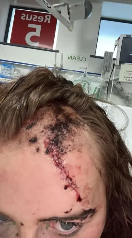 Emily was forced to receive 19 stitches. (WalesOnline/Media Wales)