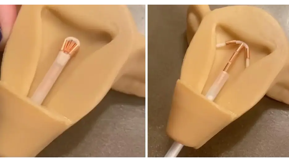 Video shows the painful reality of IUD implants