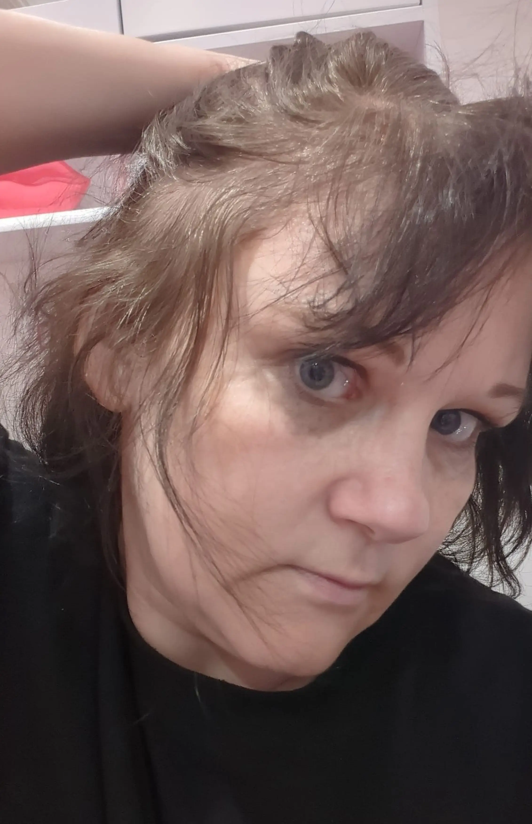 She claims her hair is now falling out in clumps and she's been forced to wear wigs (Kennedy News and Media)