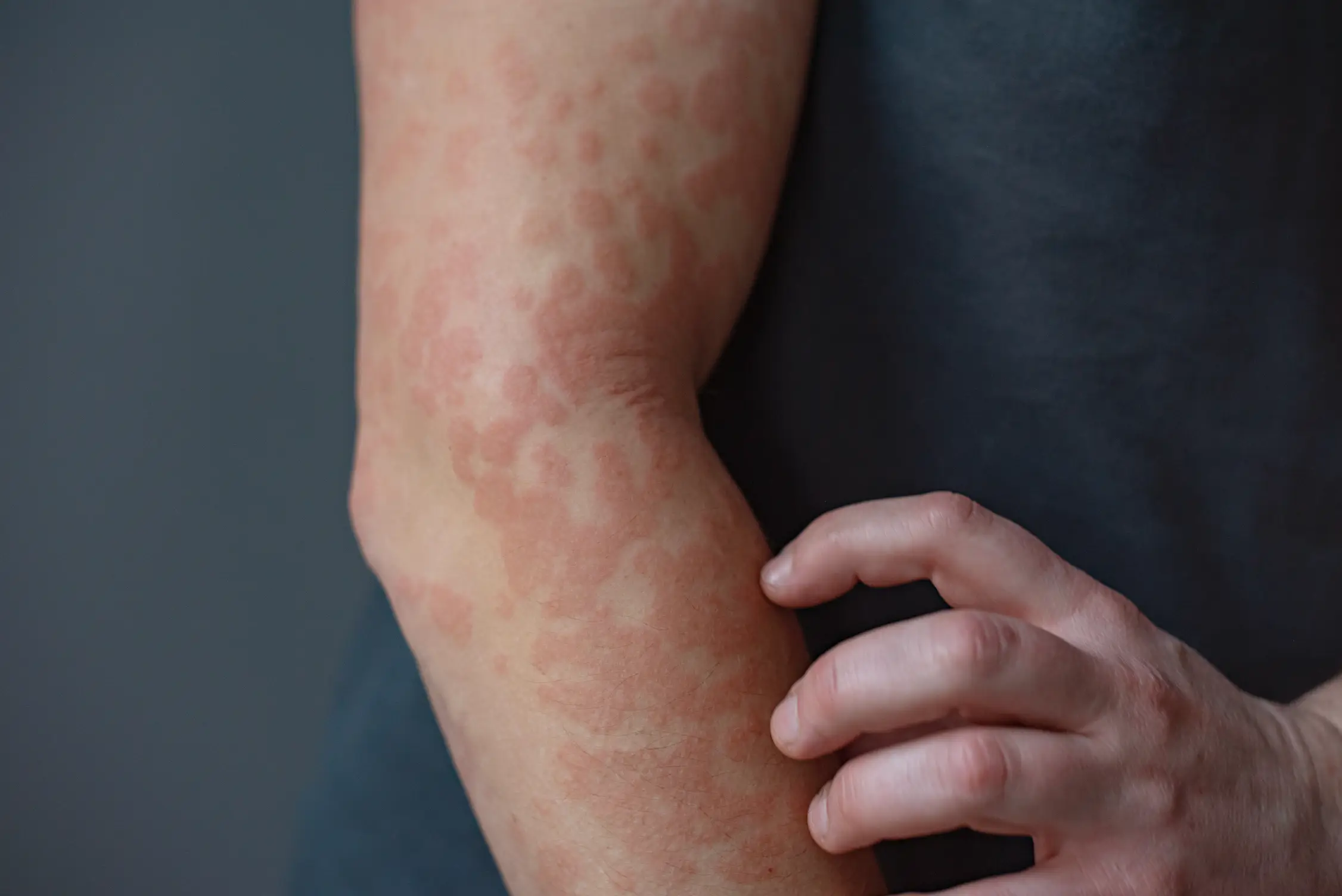 The condition can cause white scaly patches to appear (Getty Stock Images)