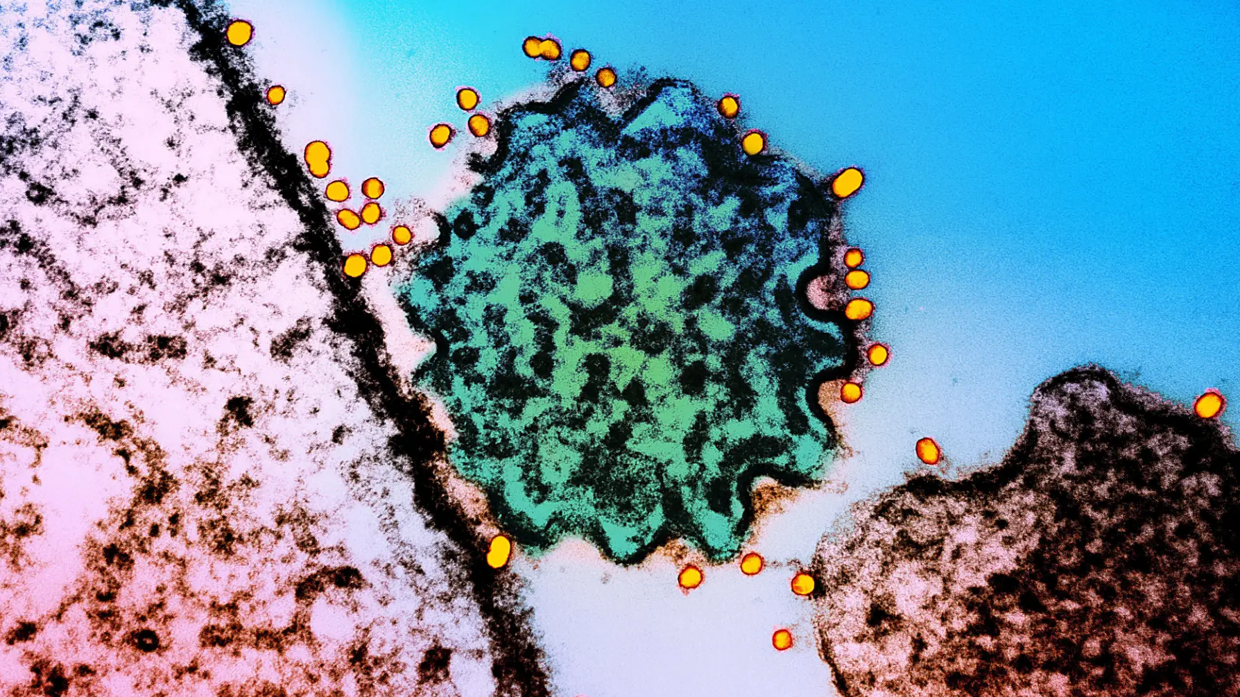 NIH-NIAID/Image Point FR/BSIP/Universal Images Group via Getty Images