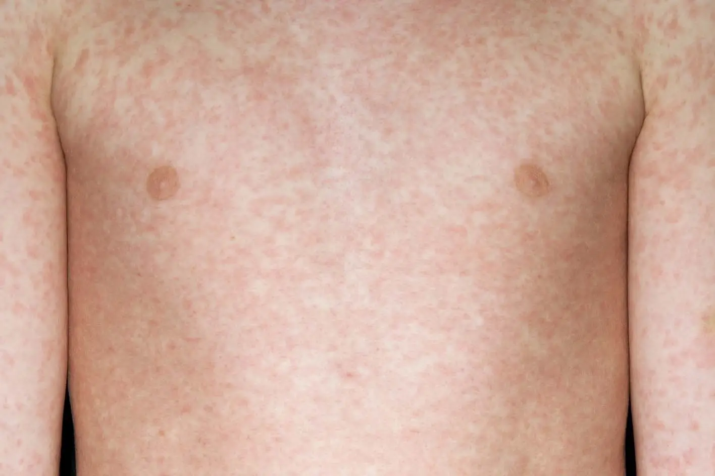 A rash usually appears a few days after the cold-like symptoms (NHS)